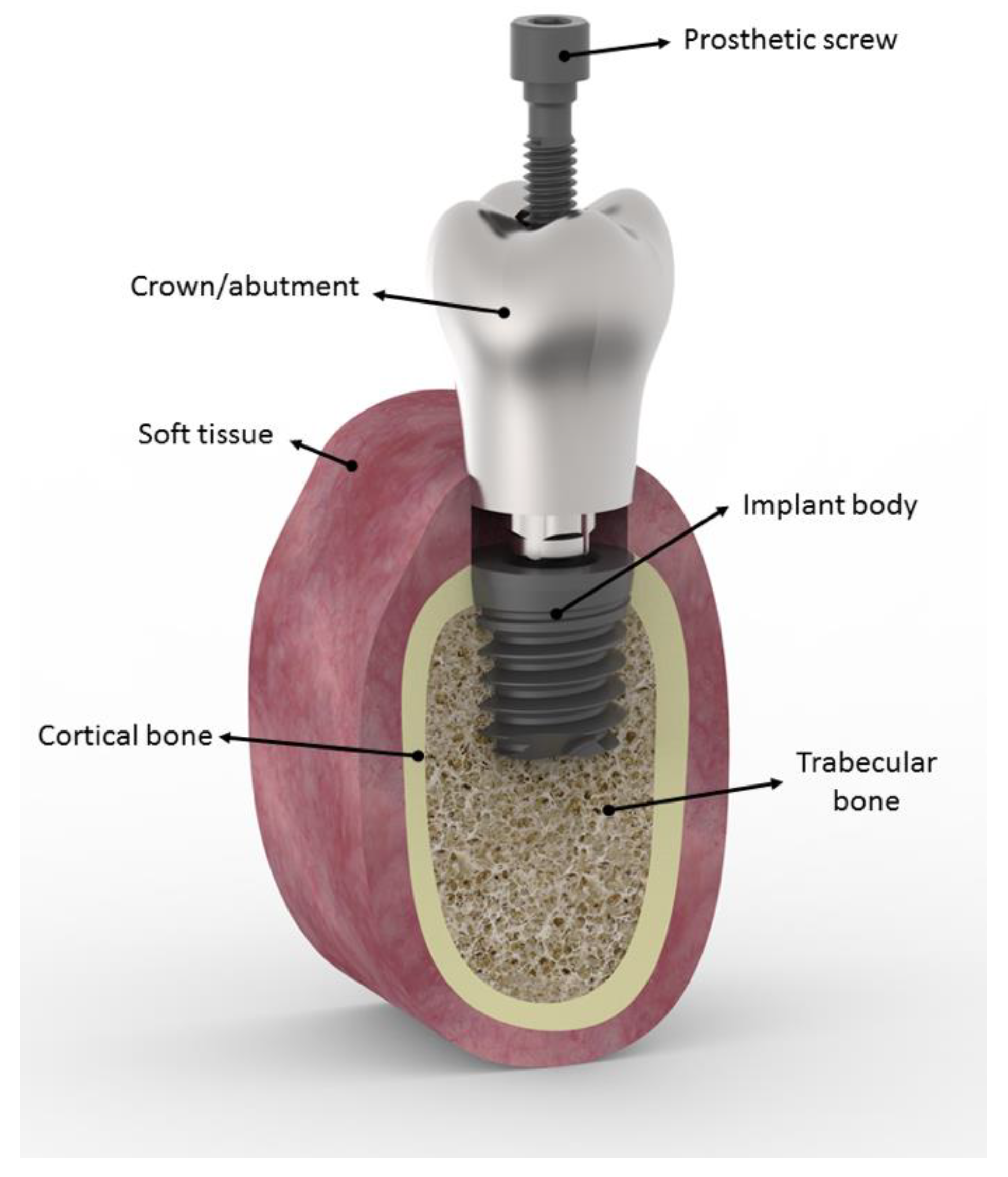 Metals Free Full Text Fatigue Design Of Dental Implant Assemblies A Nominal Stress Approach Html Metals Free Full Text Fatigue Design Of Dental Implant Assemblies A Nominal Stress Approach Html