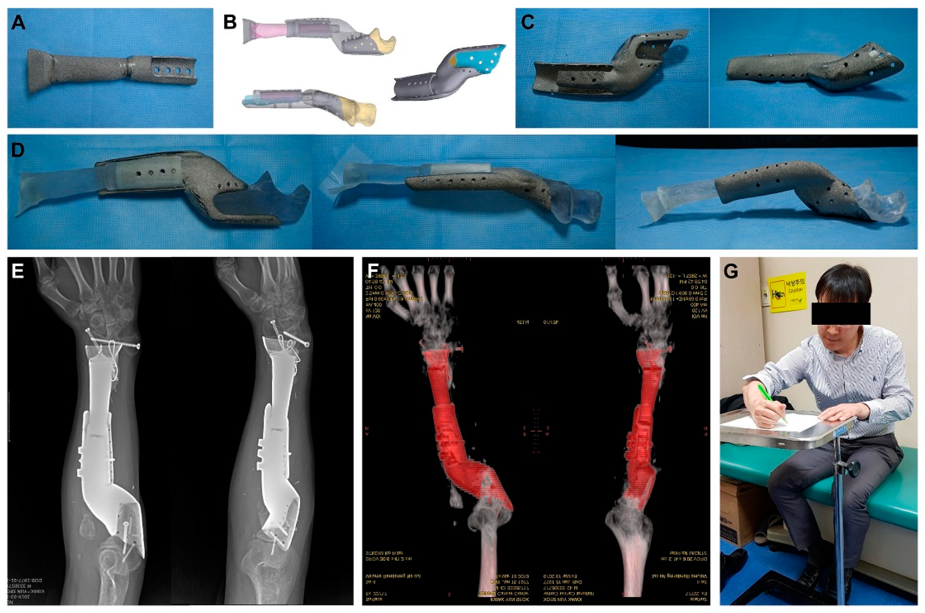 3D-Printed Connector for Revision Limb Salvage Surgery in