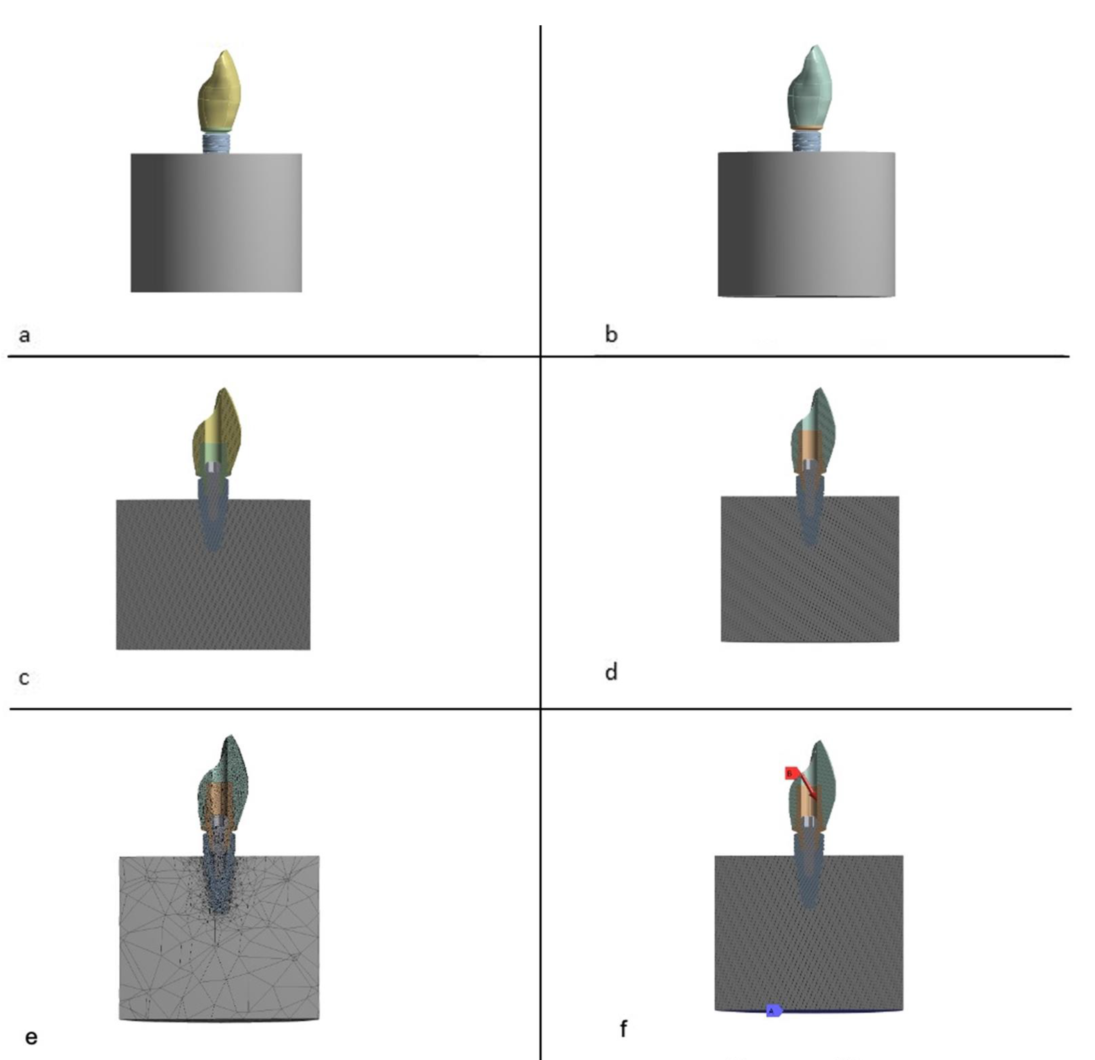 Influence of CAD/CAM Abutment Heights on the Biomechanical Behavior of ...