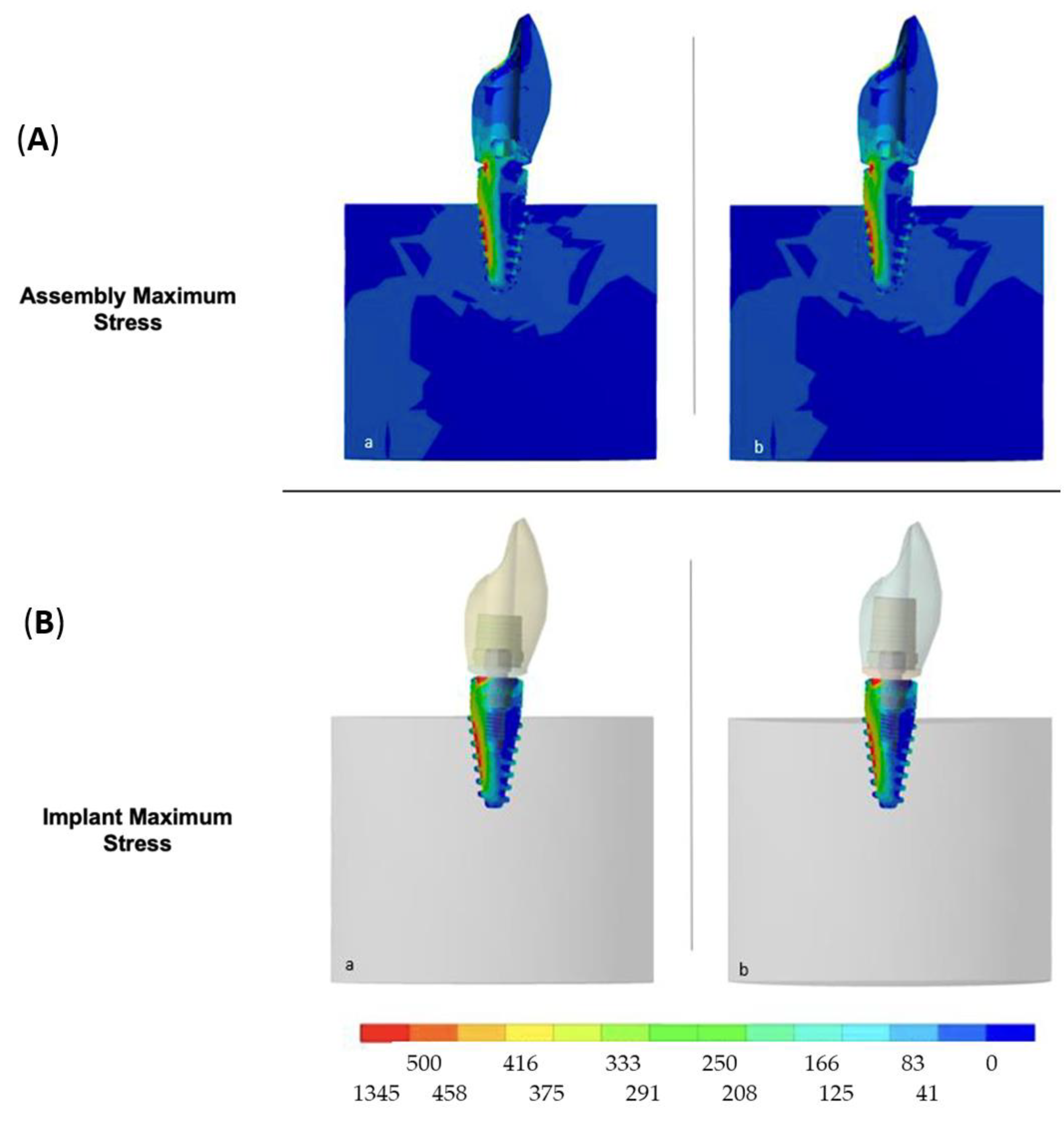 Influence of CAD/CAM Abutment Heights on the Biomechanical Behavior of ...
