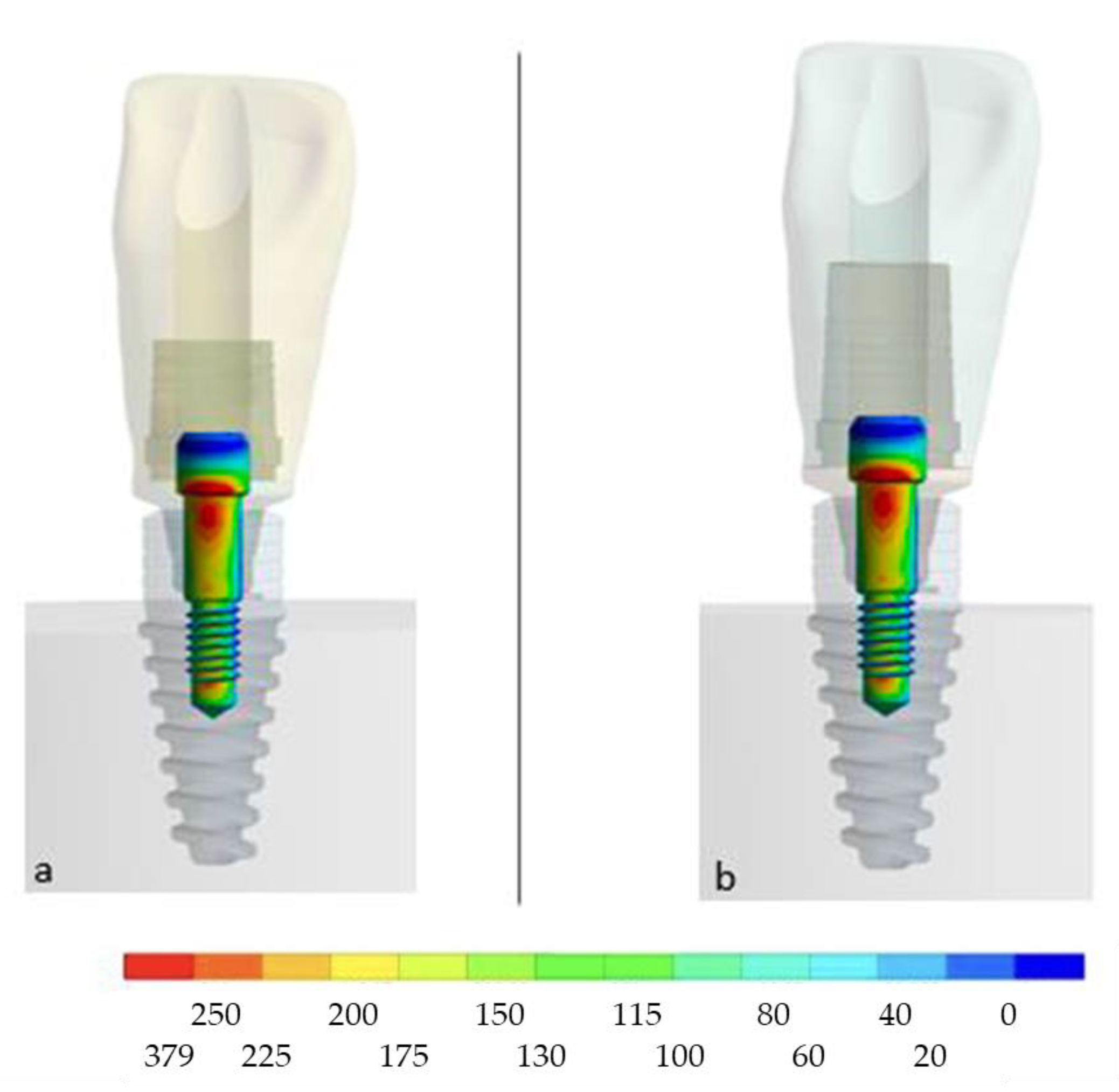 Influence of CAD/CAM Abutment Heights on the Biomechanical Behavior of ...