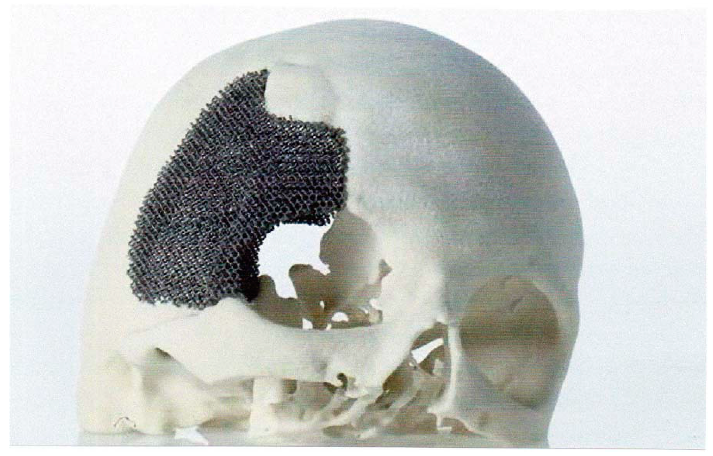 Ti 6al 4v. Стереолитография черепа. 3д принтер в медицине импланты. Стереолитография в медицине. Аддитивного производства имплантат.