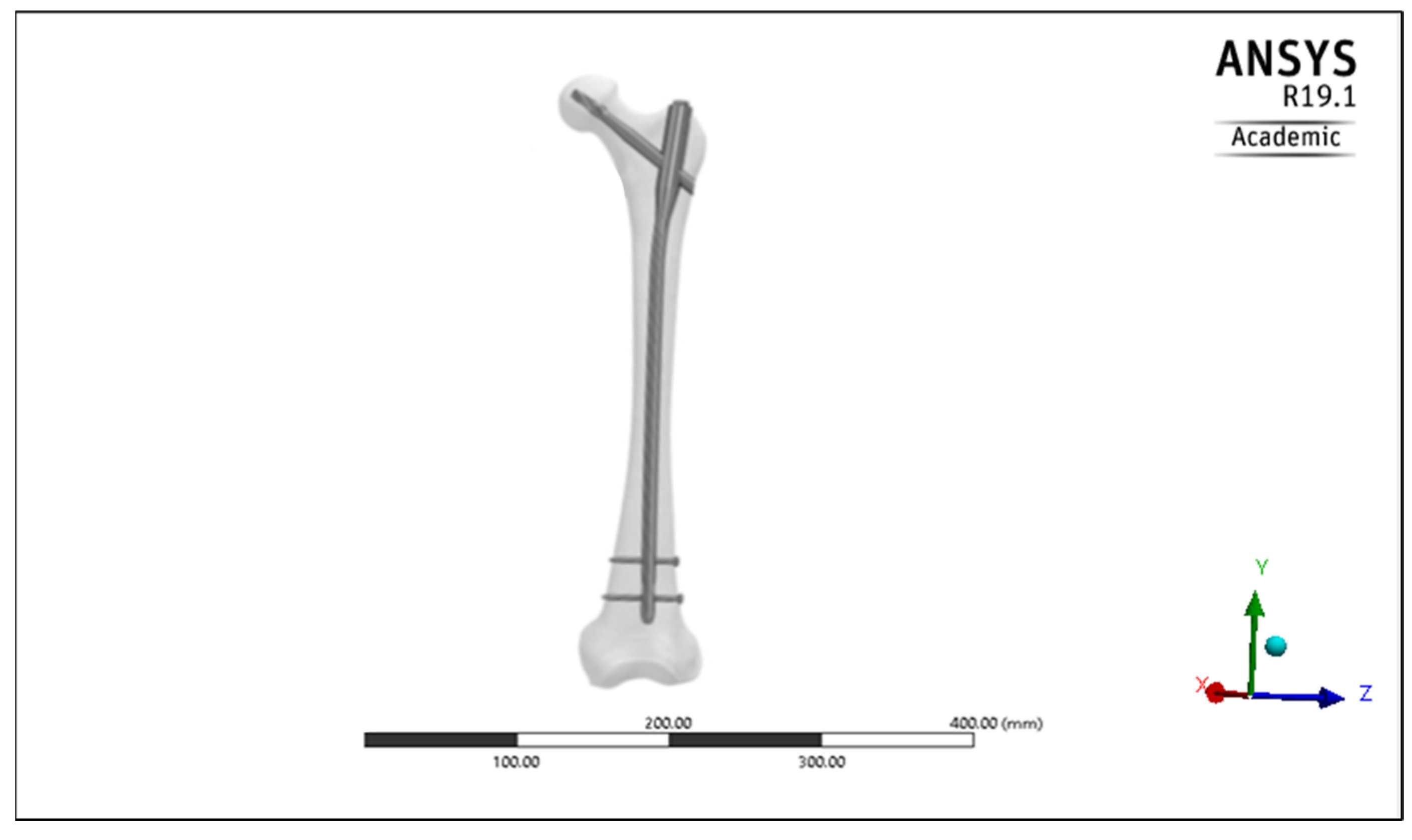 Double Medical Titanium Elastic Nail - YouTube