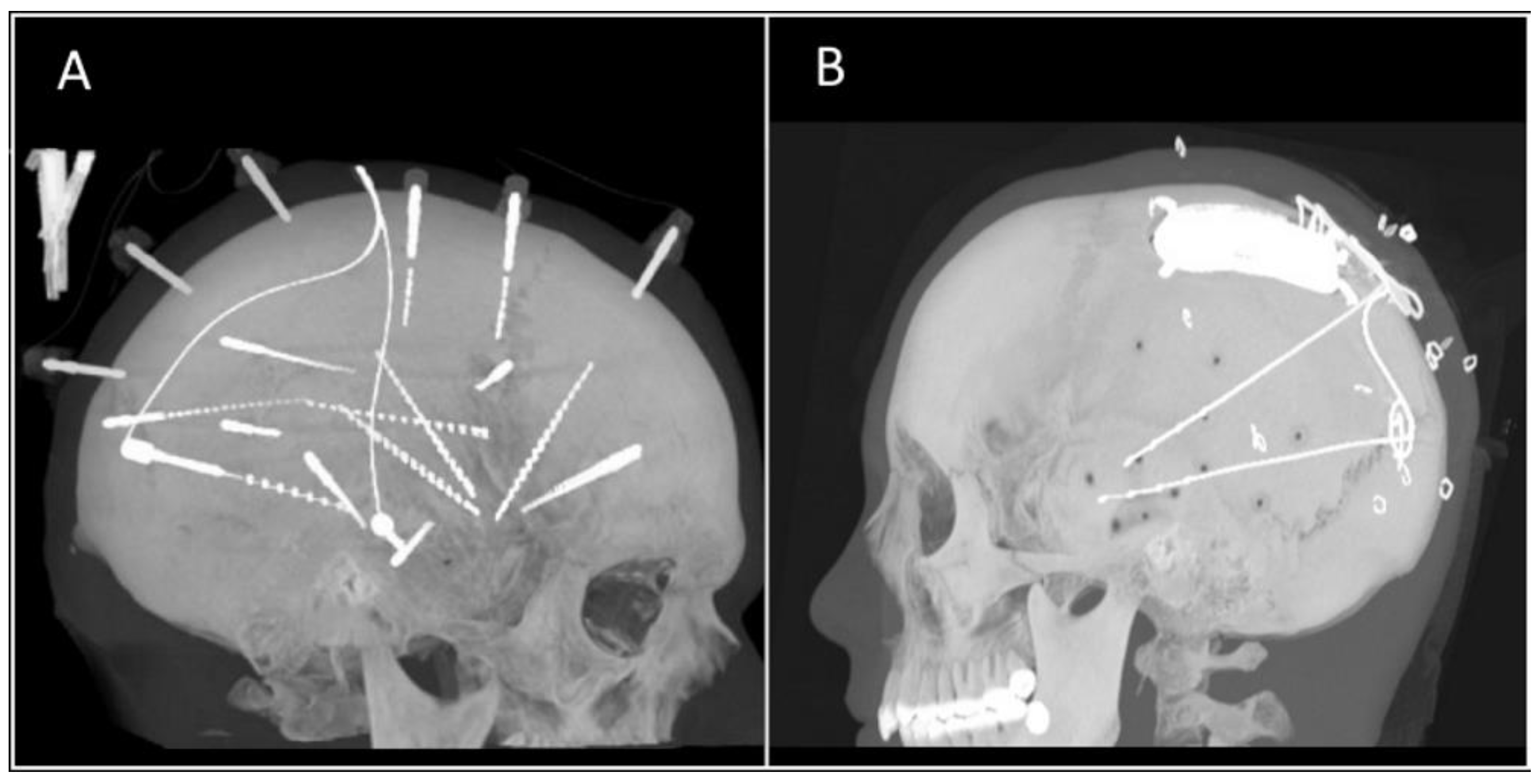 Micromachines Free FullText Chronically Implanted Intracranial