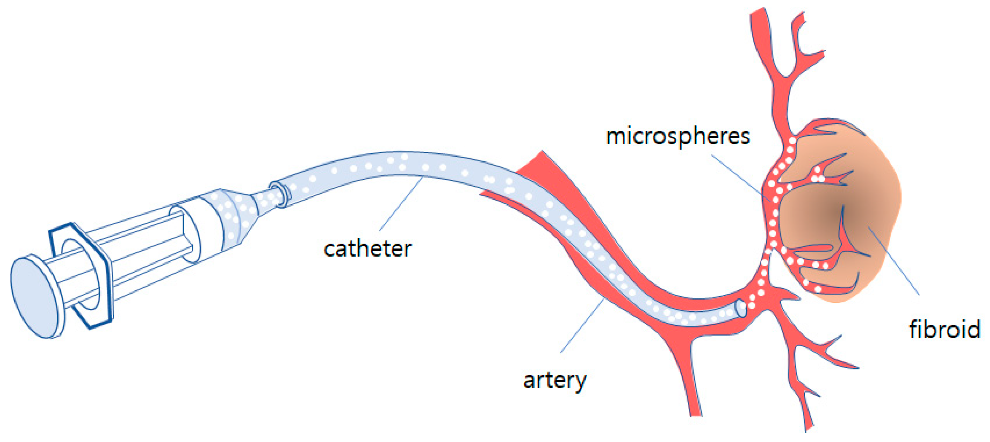 Micromachines Free FullText Prevention of Microsphere Blockage in