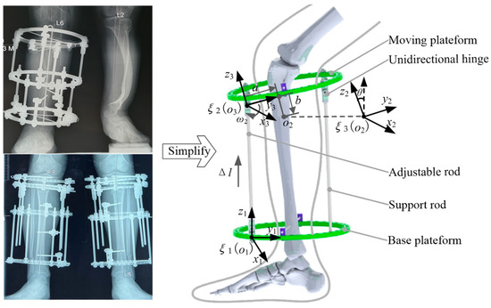 Orthopedic Trauma External Fixation Surgery Rings for Fixators - China  Limbs Fixator, Illizarov External Fixation