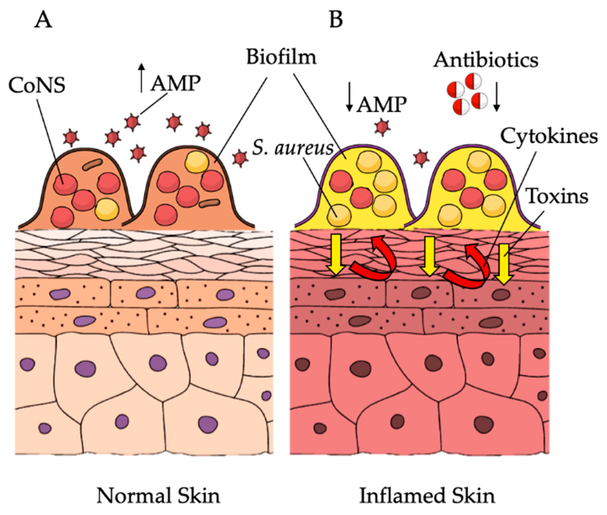 Taming Staphylococcus aureus in the eczema skin microbiome