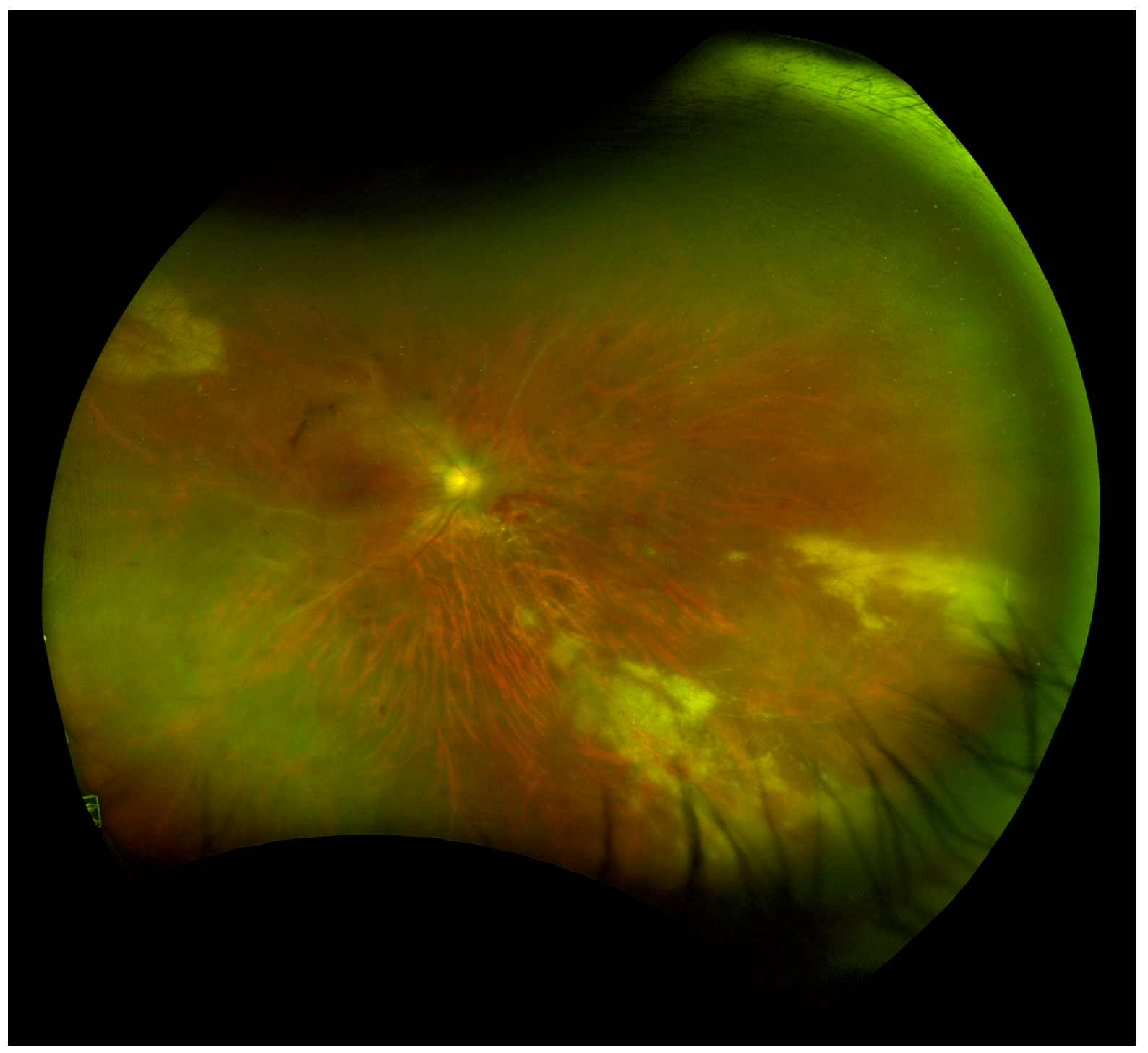 cmv retinitis