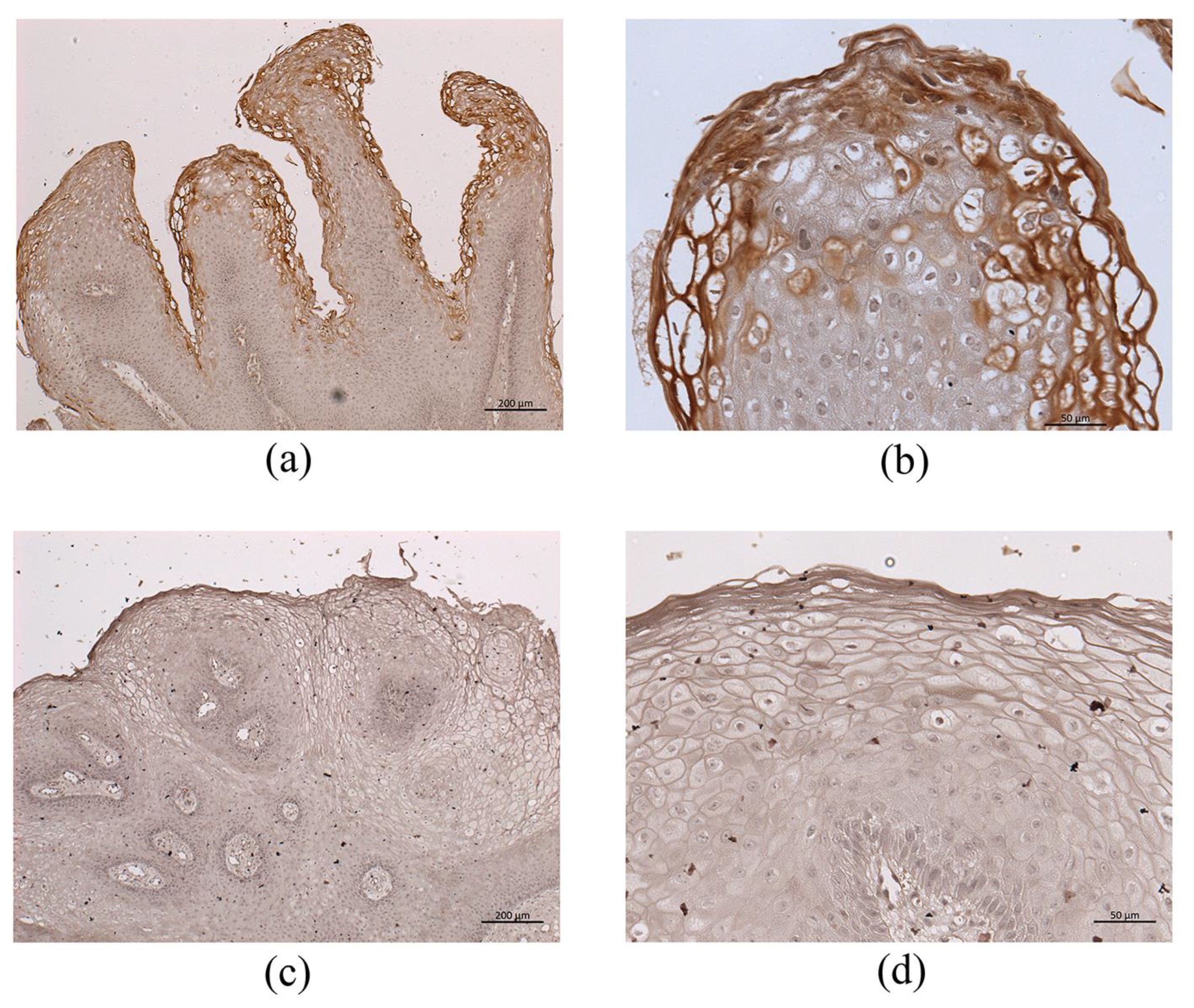 papilloma seno b3