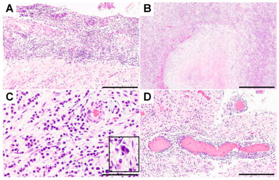 Microorganisms | Free Full-Text | Syphilitic Gummata in the Central Nervous  System: A Narrative Review and Case Report about a Noteworthy Clinical  Manifestation