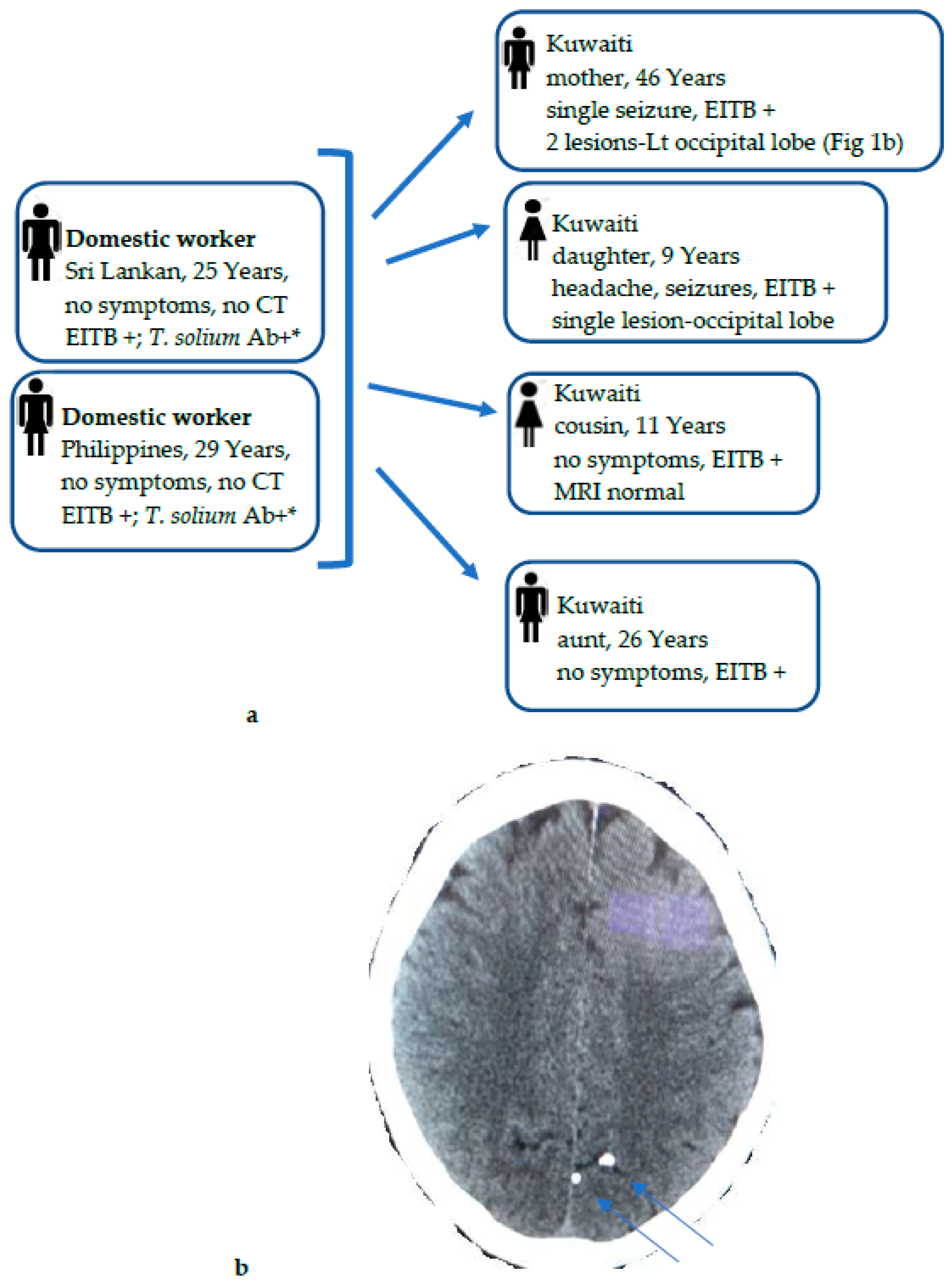 Tumefactive demyelinating lesions | MedLink Neurology