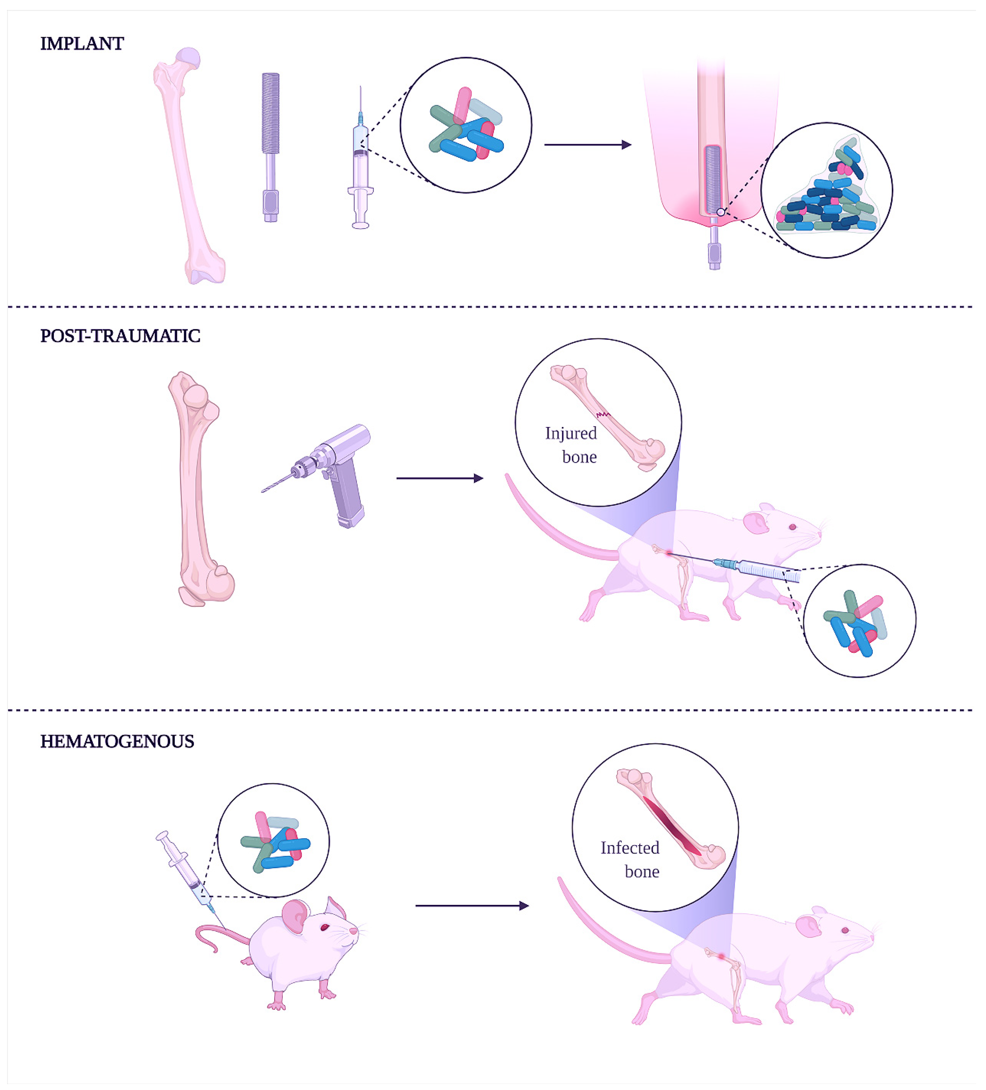 Fracture-Related Infection of the tibia due to a polymicrobial