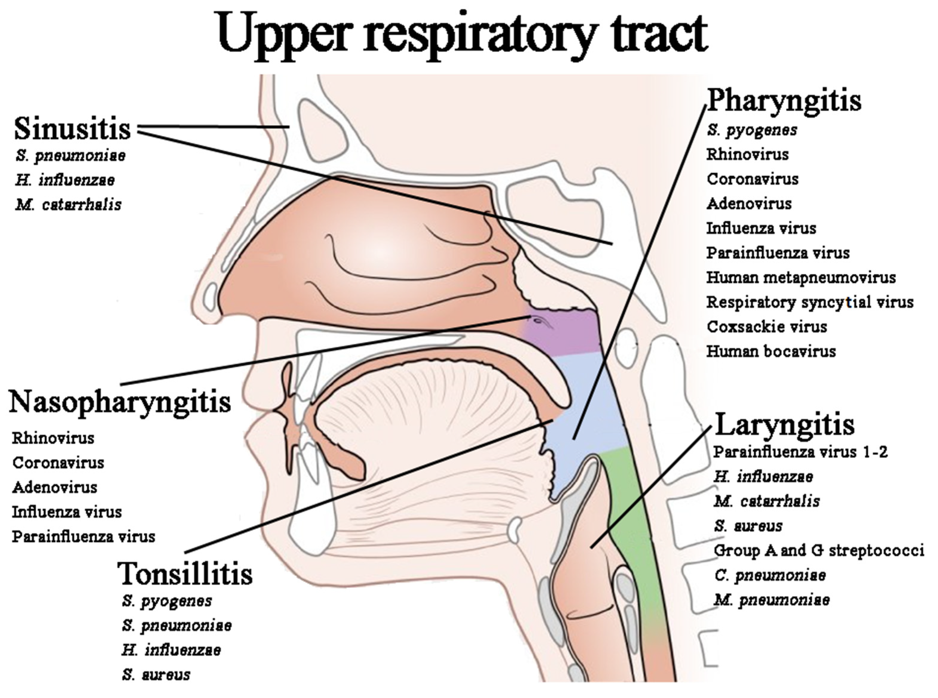 laryngitis diagram