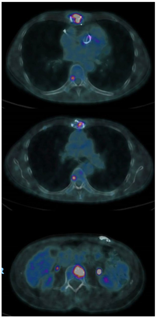 Multidisciplinary Management of Sternal Osteomyelitis Due to Klebsiella ...