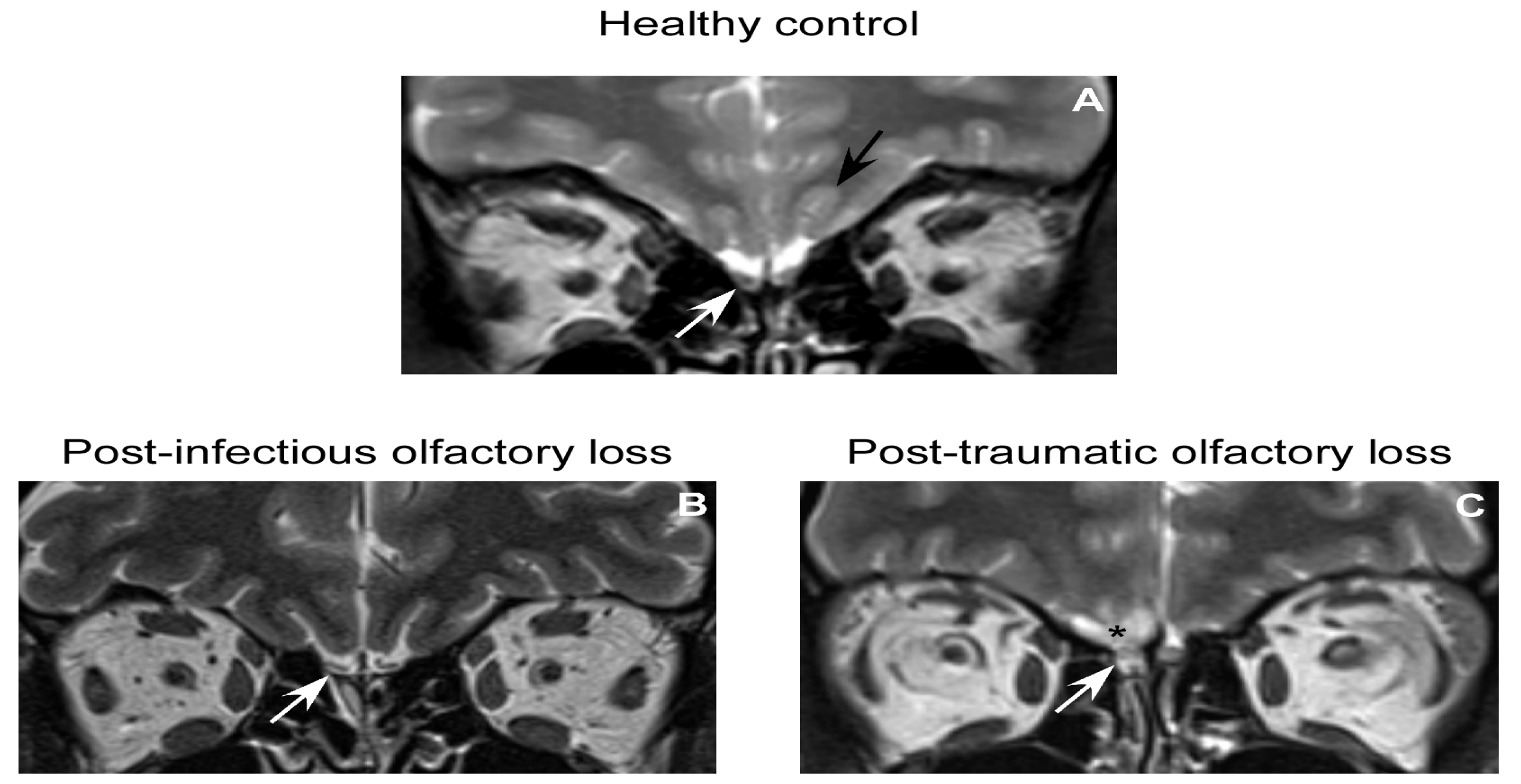 Plasticity of the Human Olfactory System: The Olfactory Bulb