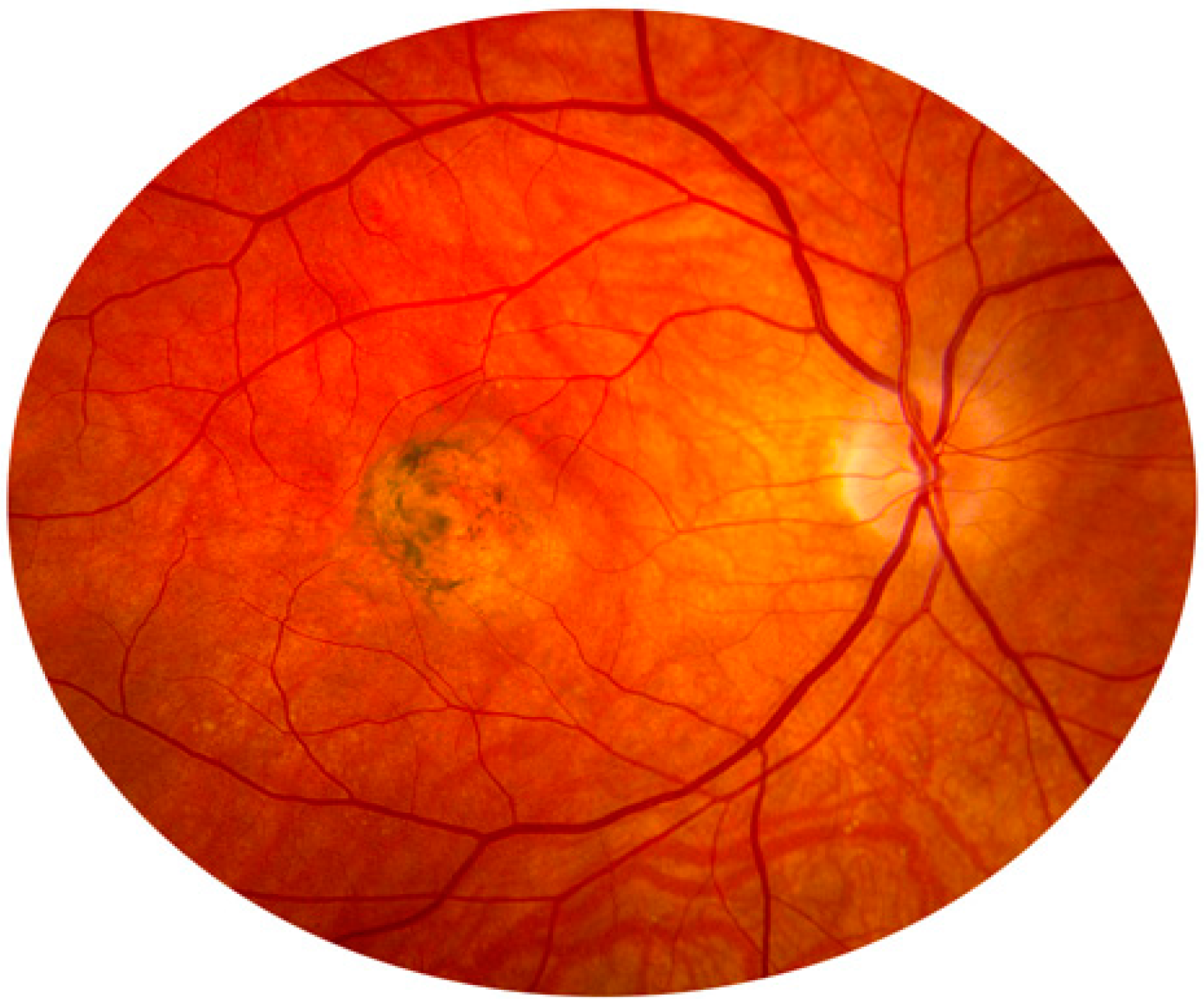 Ангиопатия сетчатки мкб 10. Ишемическая нейропатия зрительного нерва. Ишемическая оптикопатия зрительного нерва. Задняя ишемическая нейропатия зрительного нерва. Дистрофия глазного дна Сорсби.