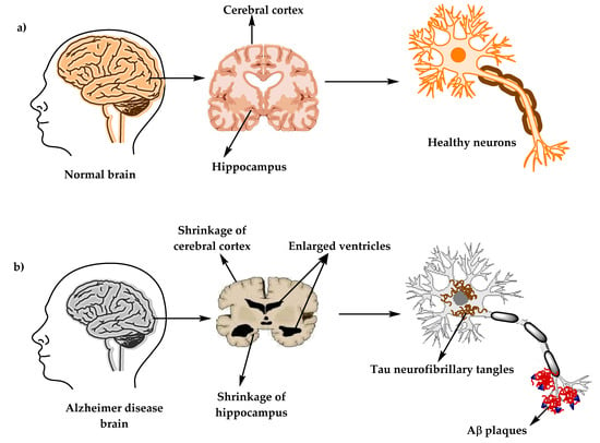 Molecules | Free Full-Text | Comprehensive Review on Alzheimer's Disease: Causes and Treatment | HTML