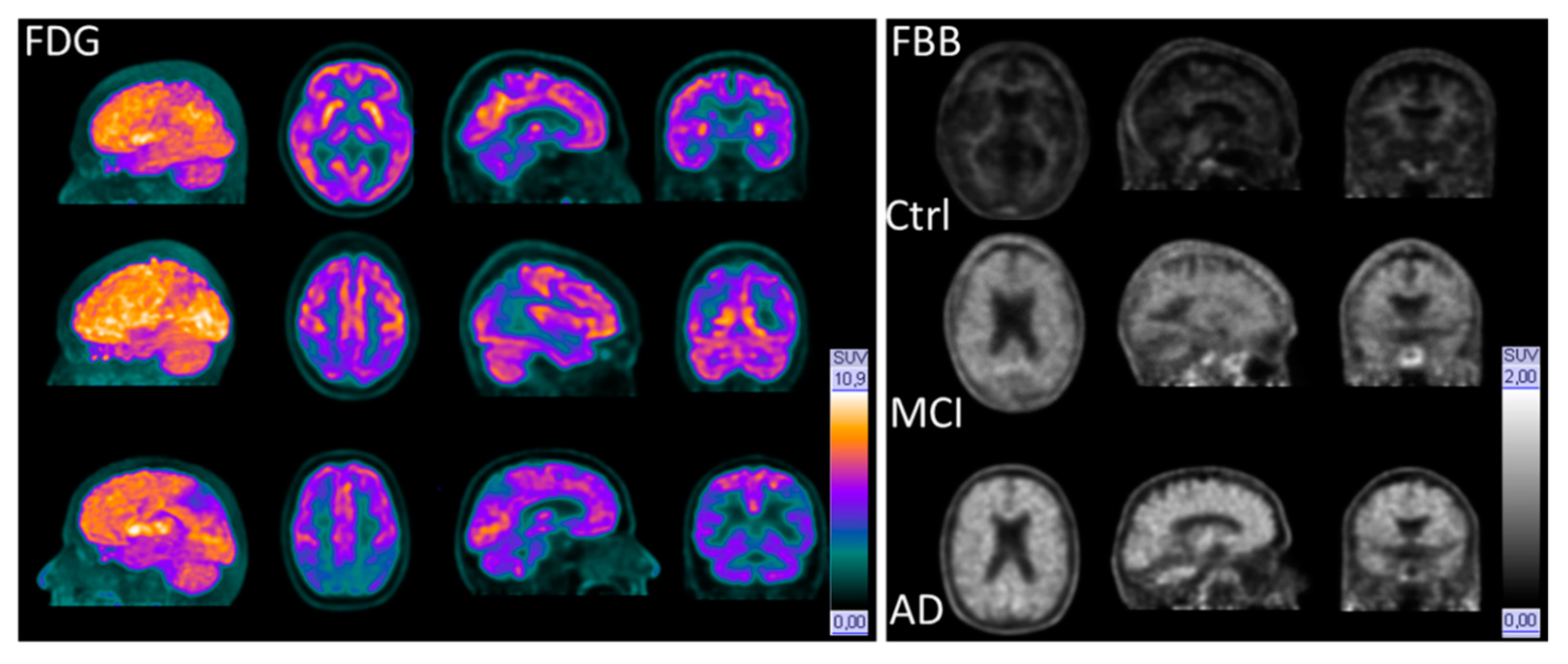 Pet scan brain dementia