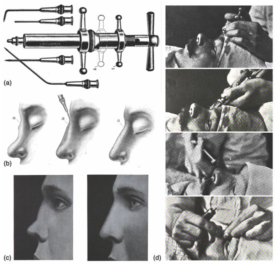 ENCYCLOPAEDIA of OCCLUSION【裁断済】 Covidien VLOCM0844 Wound Closure Device 3-0 Surgalloy CV-23