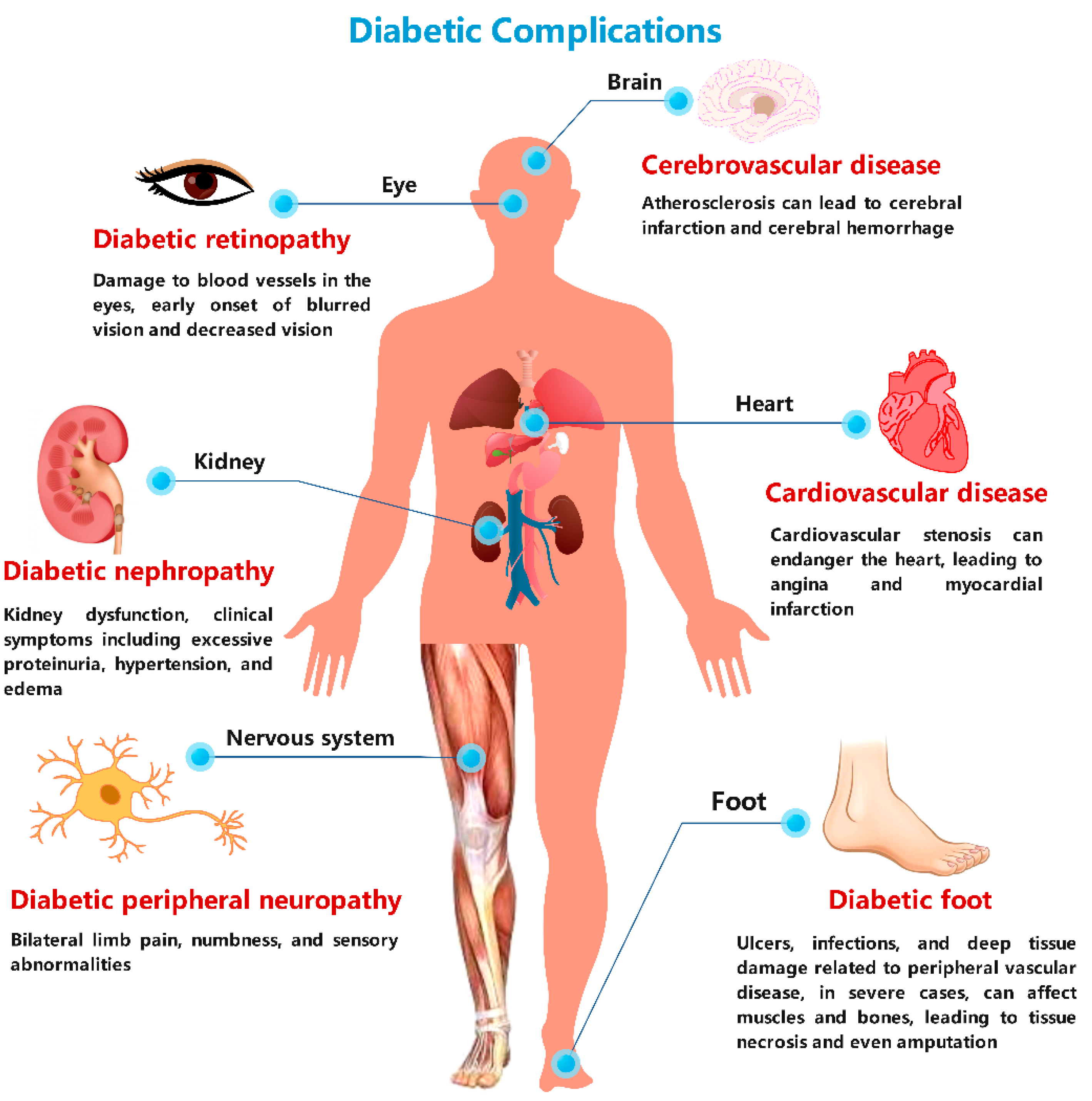 complications of diabetes