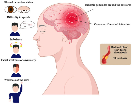 Ferroptosis in Ischemic Stroke and Related Traditional Chinese