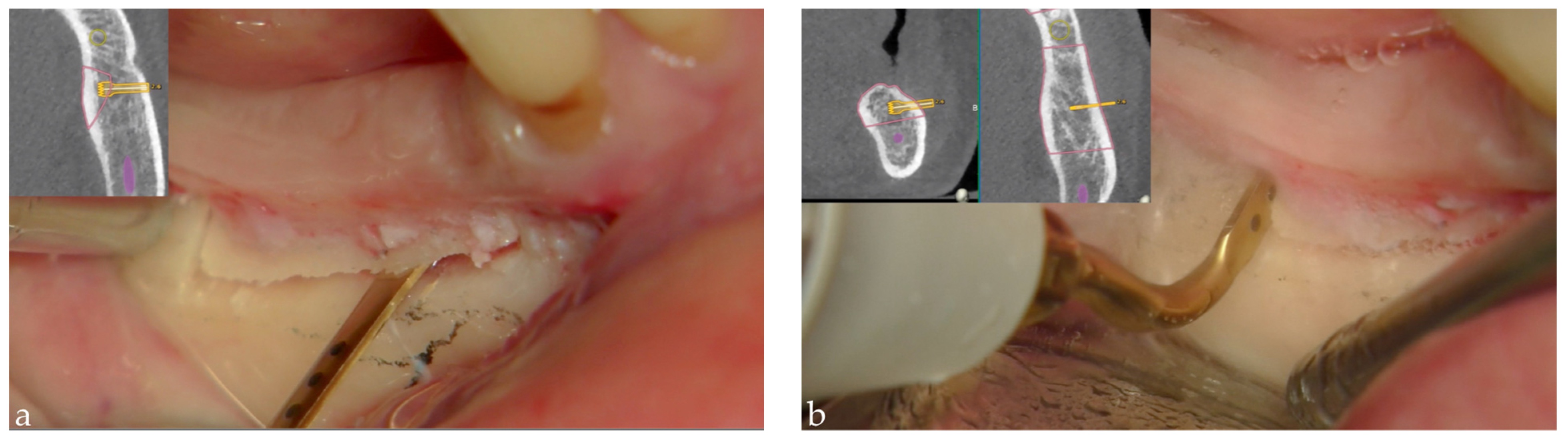 MPs Free FullText Dynamic Navigated “Sandwich” Technique A Novel Surgical Approach for