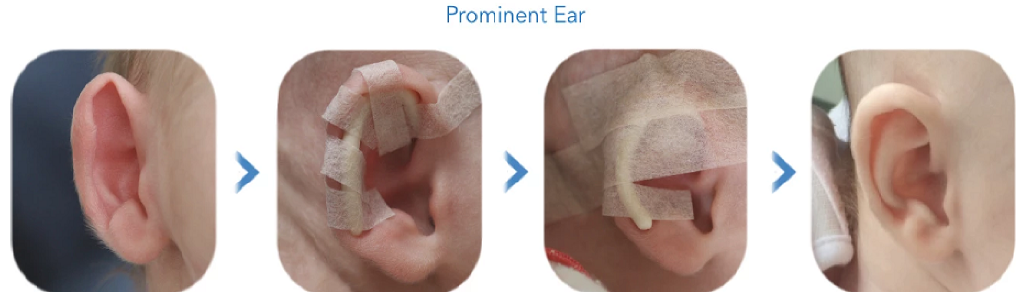 Ear Correction Tape Ear Cleaner Tool Kit Newborn Baby Ear