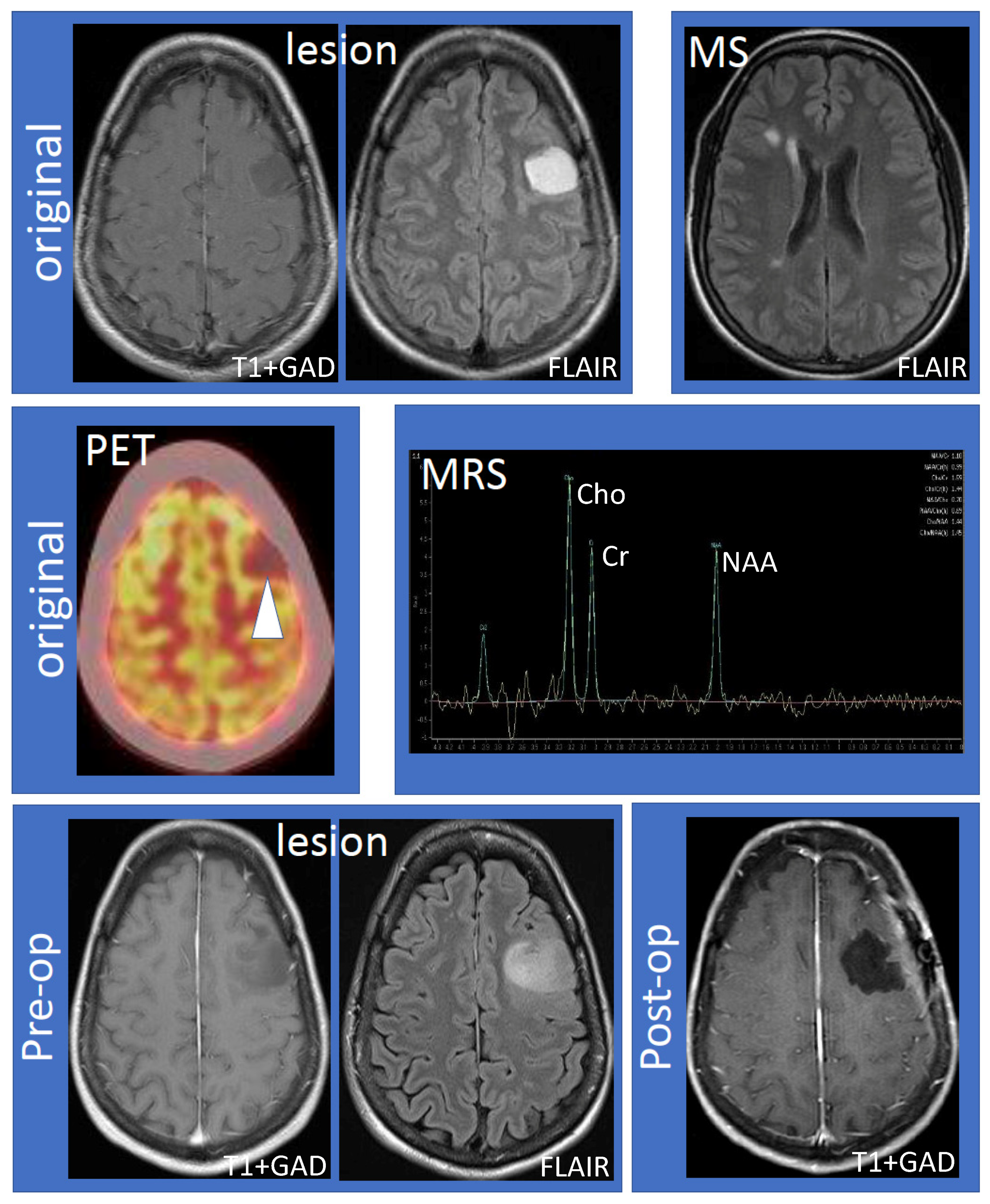 Frontiers | Multifocal brain abscesses caused by invasive Streptococcus  intermedia: A case report