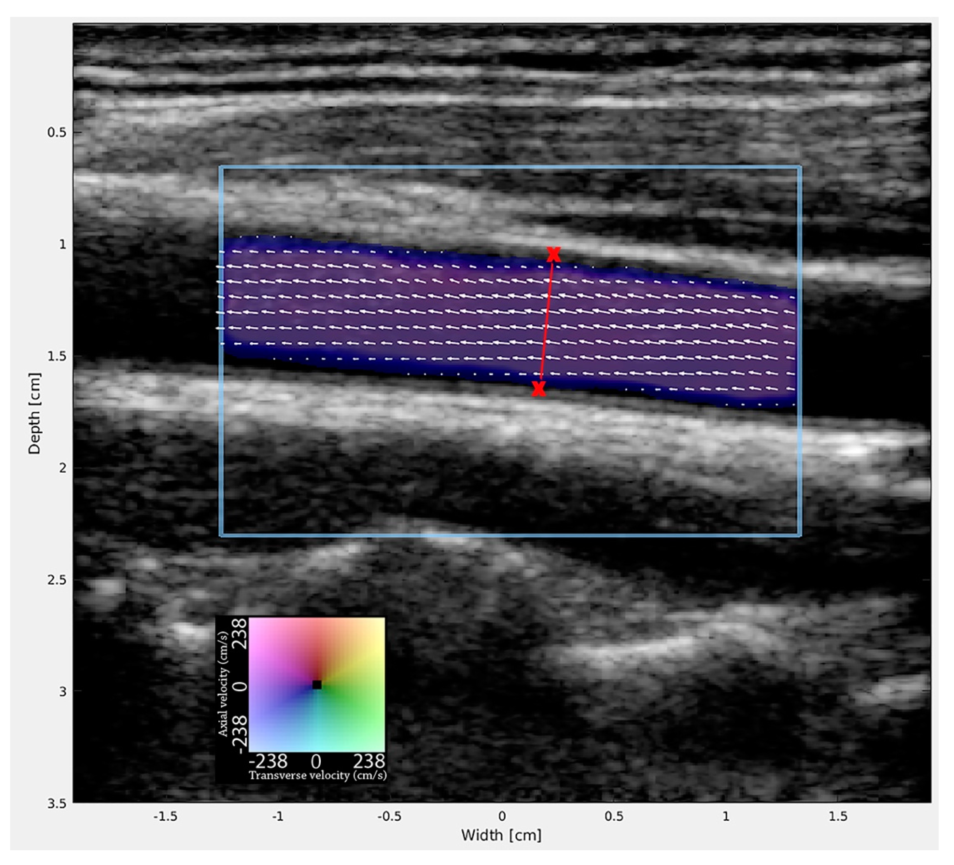 Common Carotid Artery Volume Flow: A Comparison Study between 