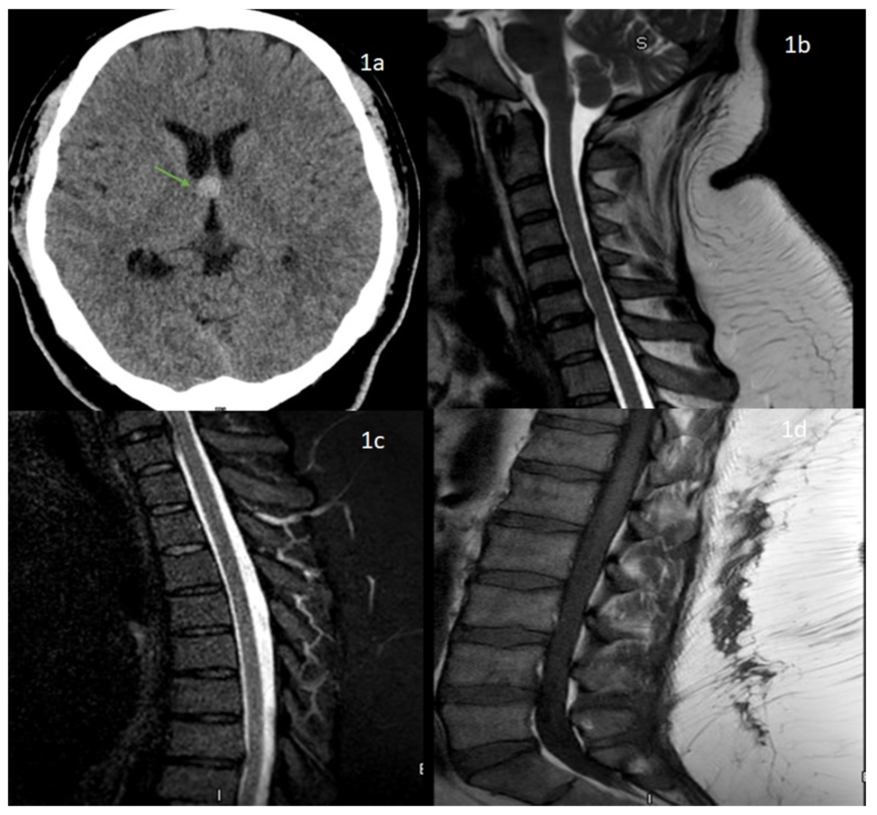 Neurology International Free Full Text A Novel Case Of Bifacial Diplegia Variant Of Guillain Barre Syndrome Following Janssen Covid 19 Vaccination Html