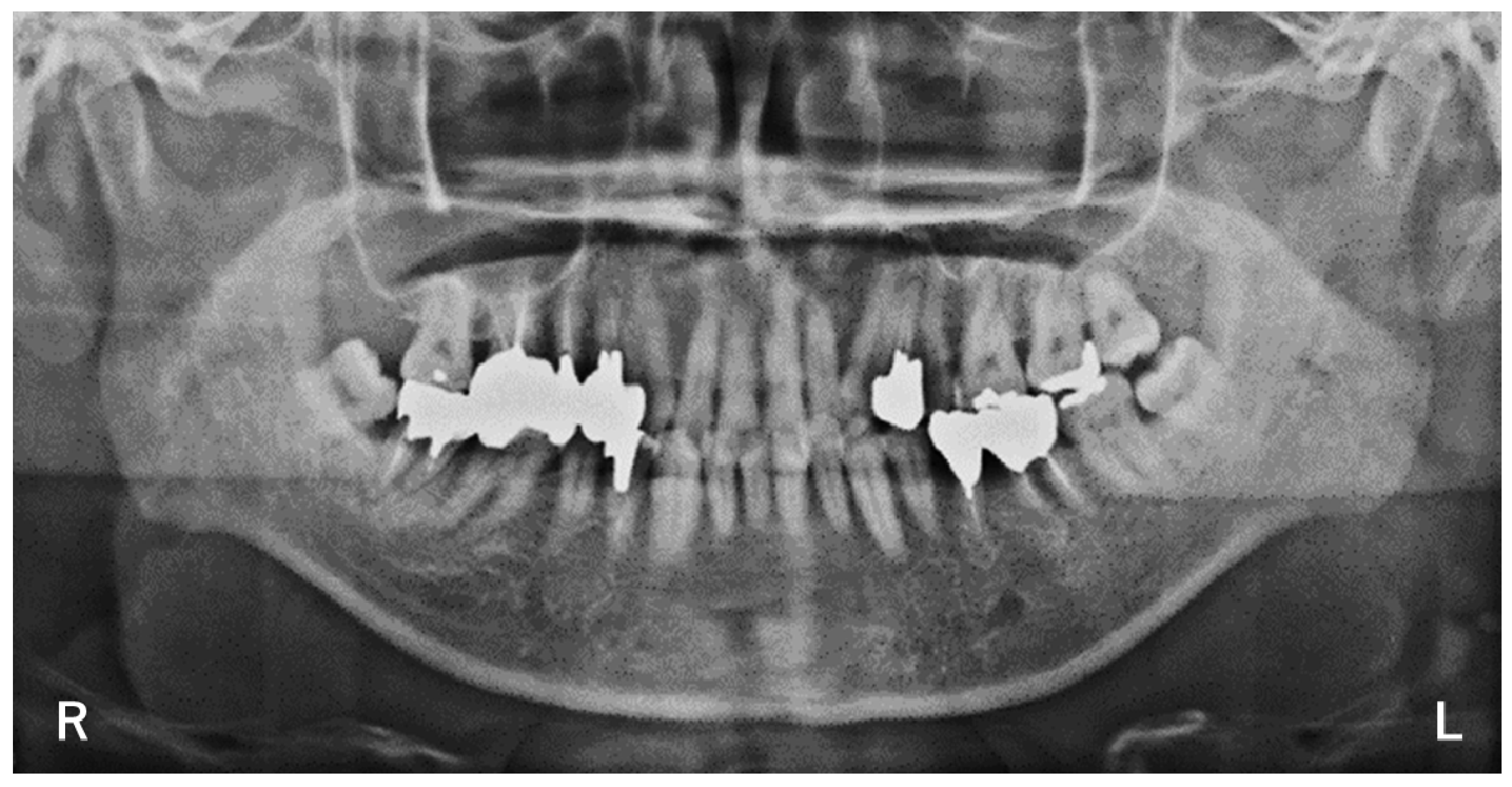Neurology International Free FullText Headache Attributed to
