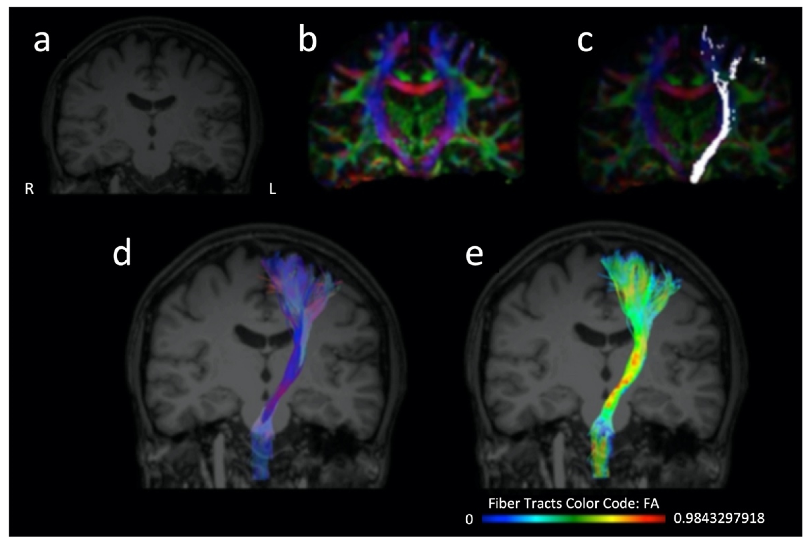 Neurology International | Free Full-Text | Diffusion Tensor Imaging as ...
