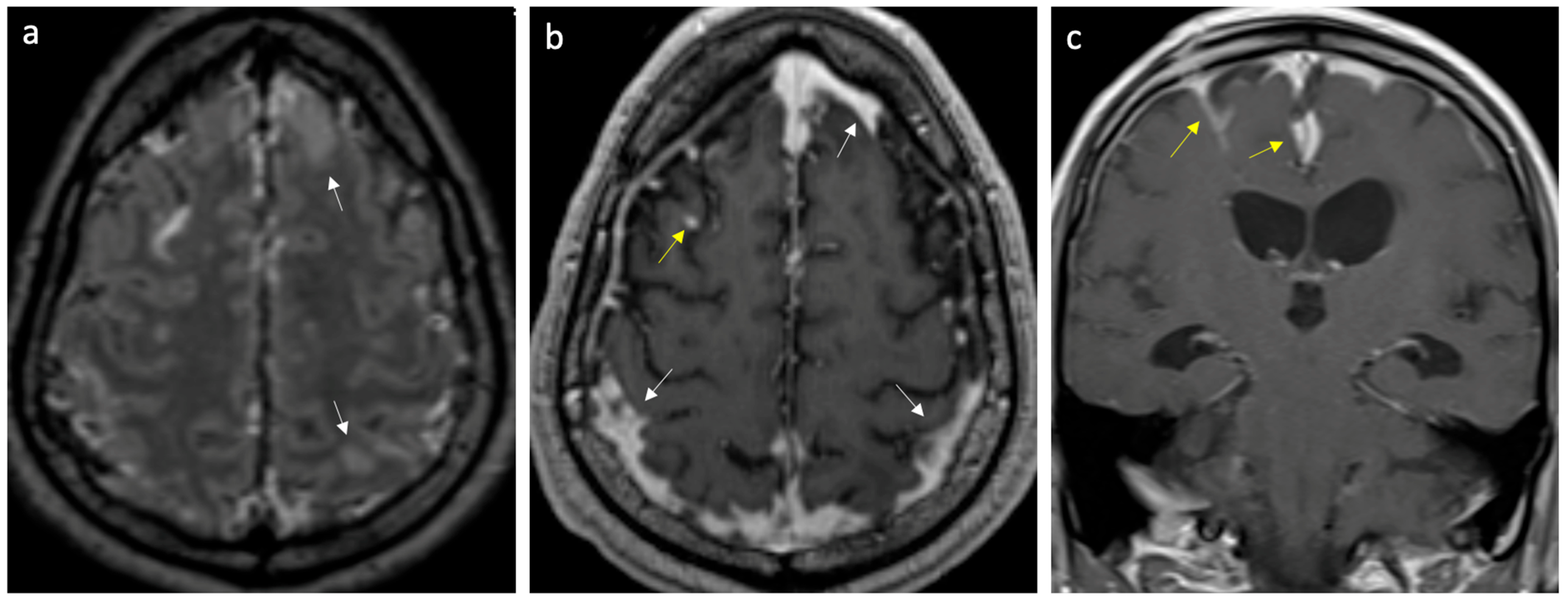The Clinical Manifestations, Risk Factors, Etiologies, and 