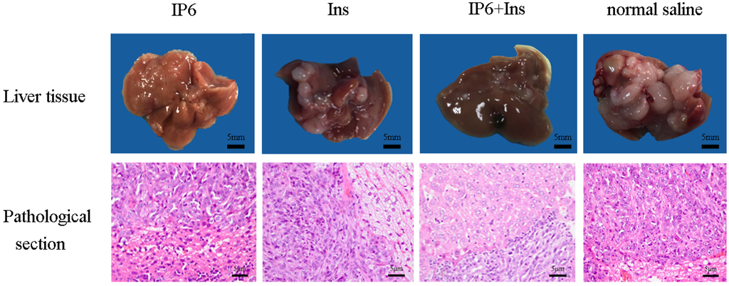 Inositol Hexaphosphate and Inositol Inhibit Colorectal Cancer 