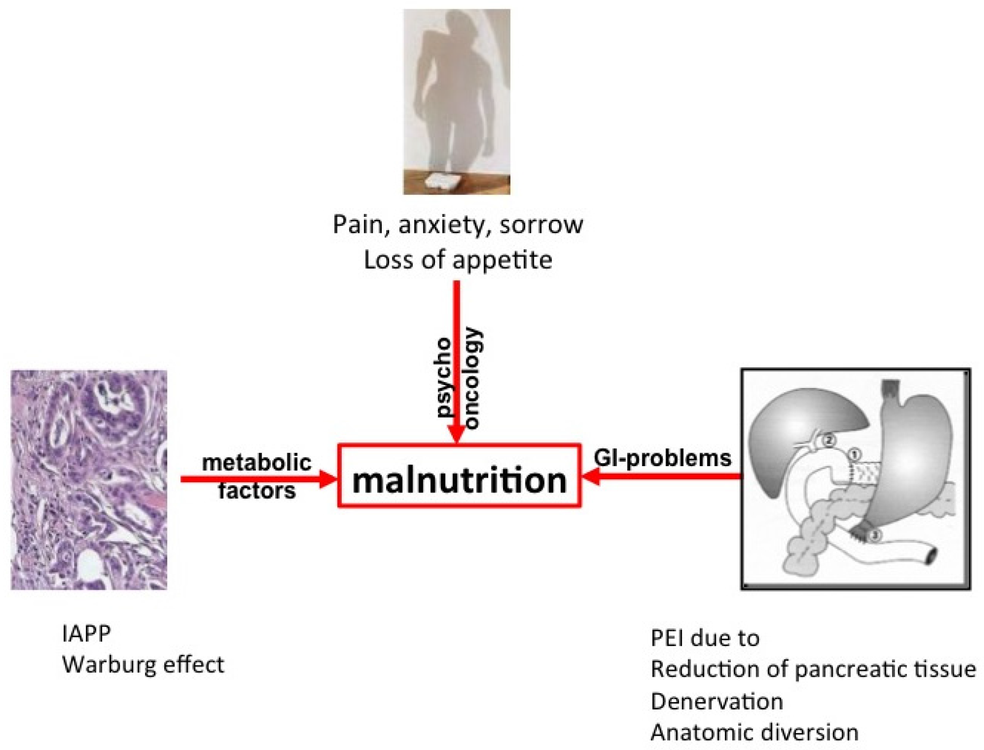 pancreatic cancer exocrine