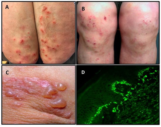 Dermatitis herpetiformis adalah