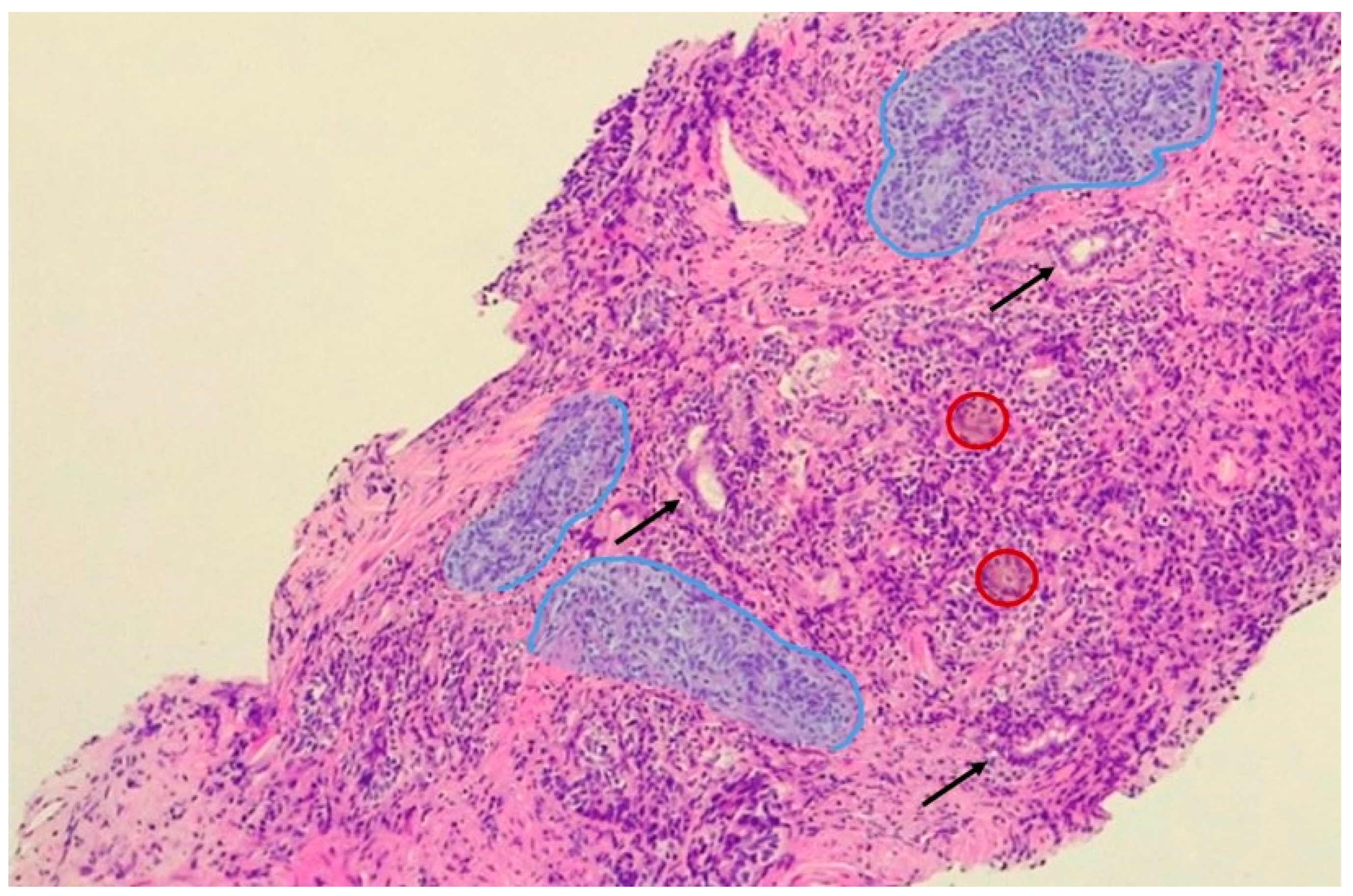 prostatitis mi az