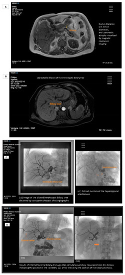 Roux-En-Y Hepaticojejunostomy and JP Drain - Trial Exhibits Inc.