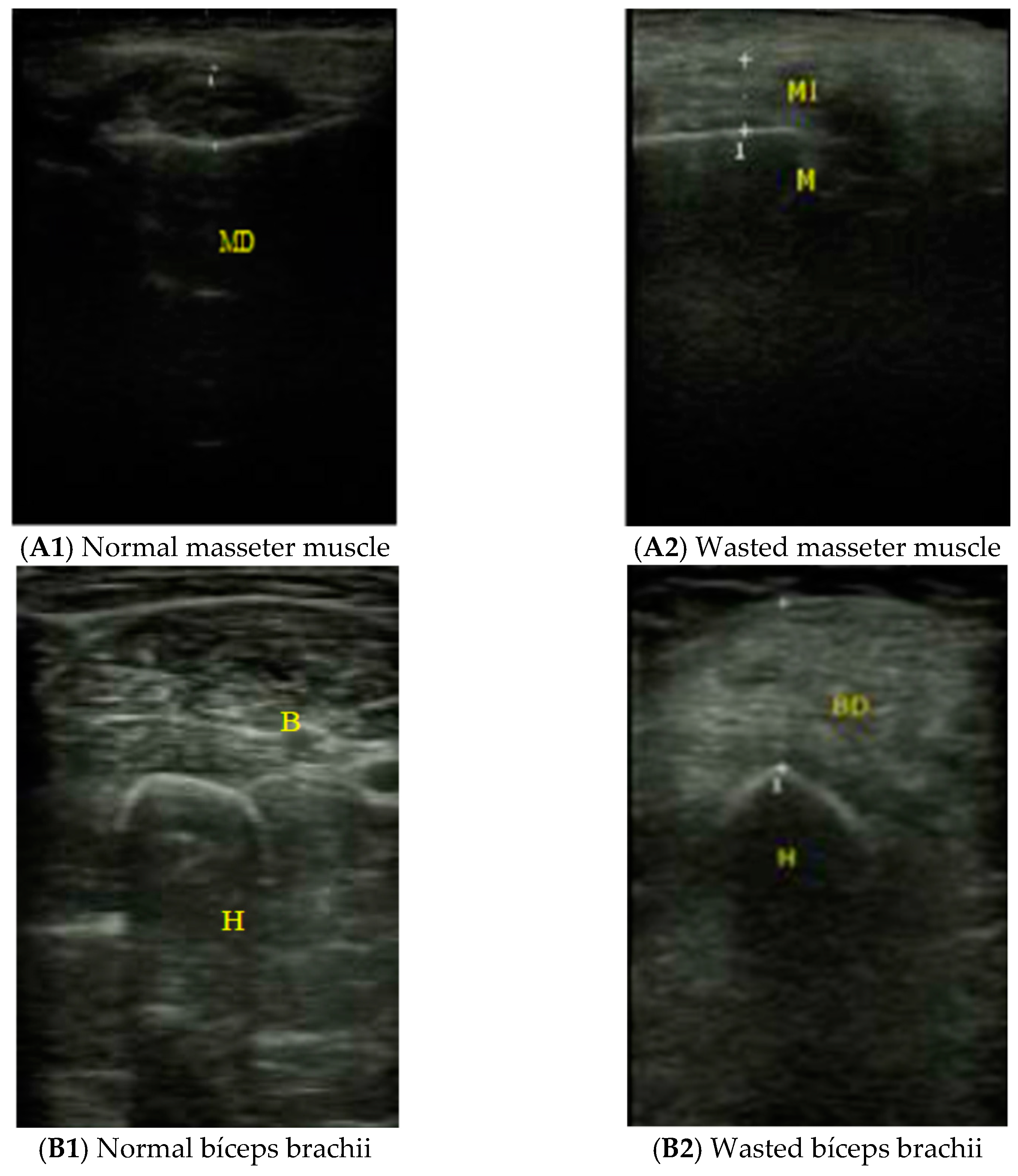 Nutrients Free Full Text Muscle Thickness And Echogenicity Measured By Ultrasound Could Detect Local Sarcopenia And Malnutrition In Older Patients Hospitalized For Hip Fracture Html