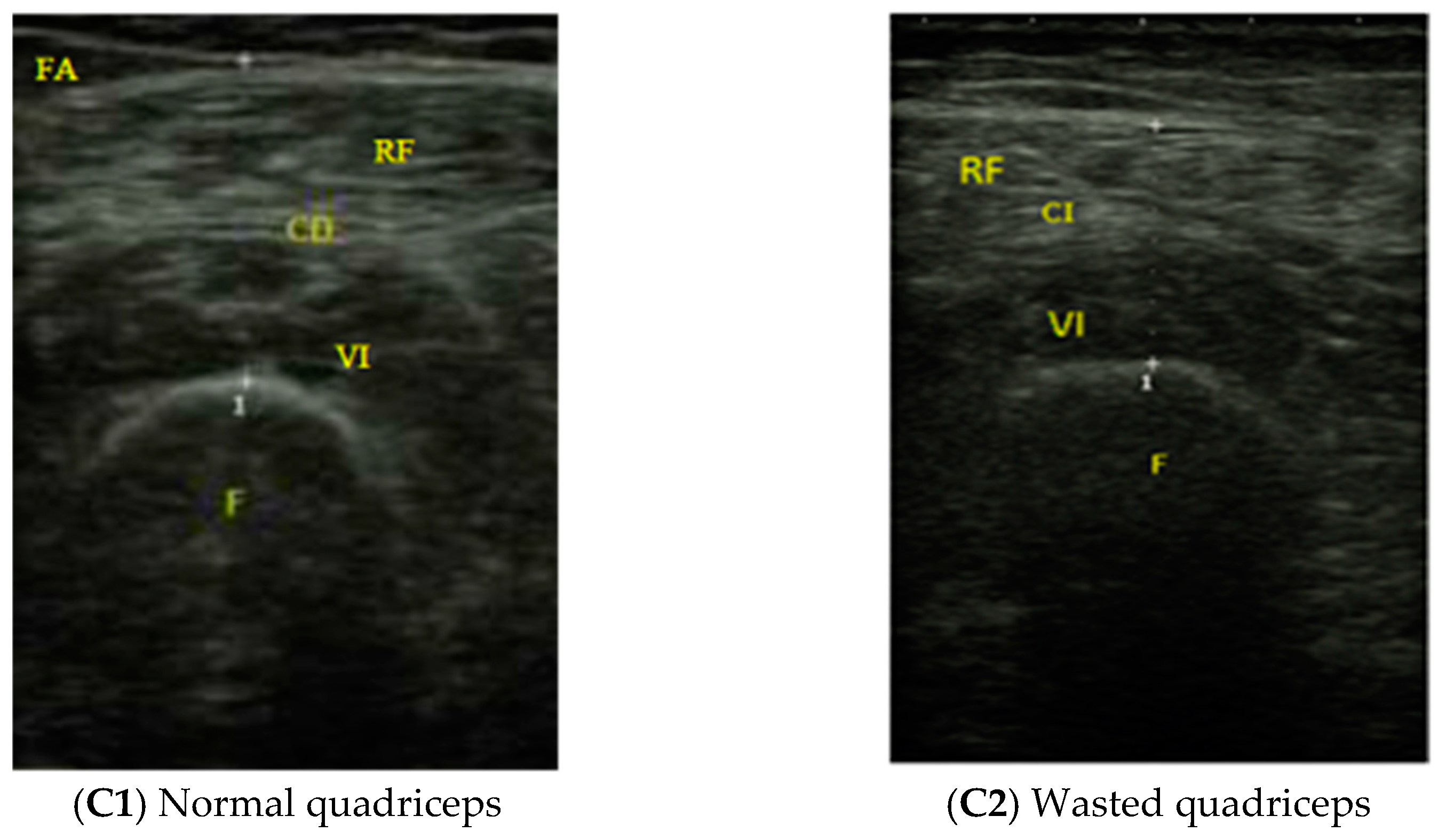 Nutrients Free Full Text Muscle Thickness And Echogenicity Measured By Ultrasound Could Detect Local Sarcopenia And Malnutrition In Older Patients Hospitalized For Hip Fracture Html