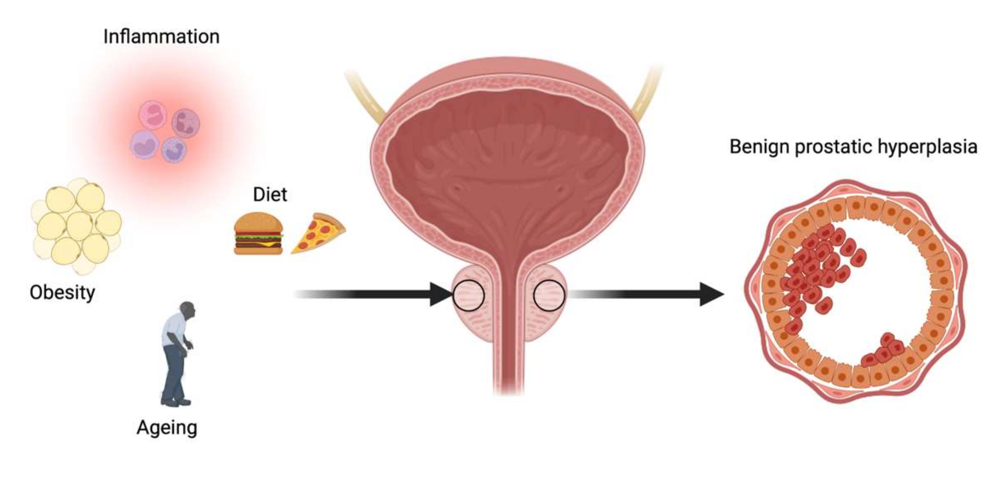 Benign prostate hyperplasia and nutrition, Prostatitis Sulfa P