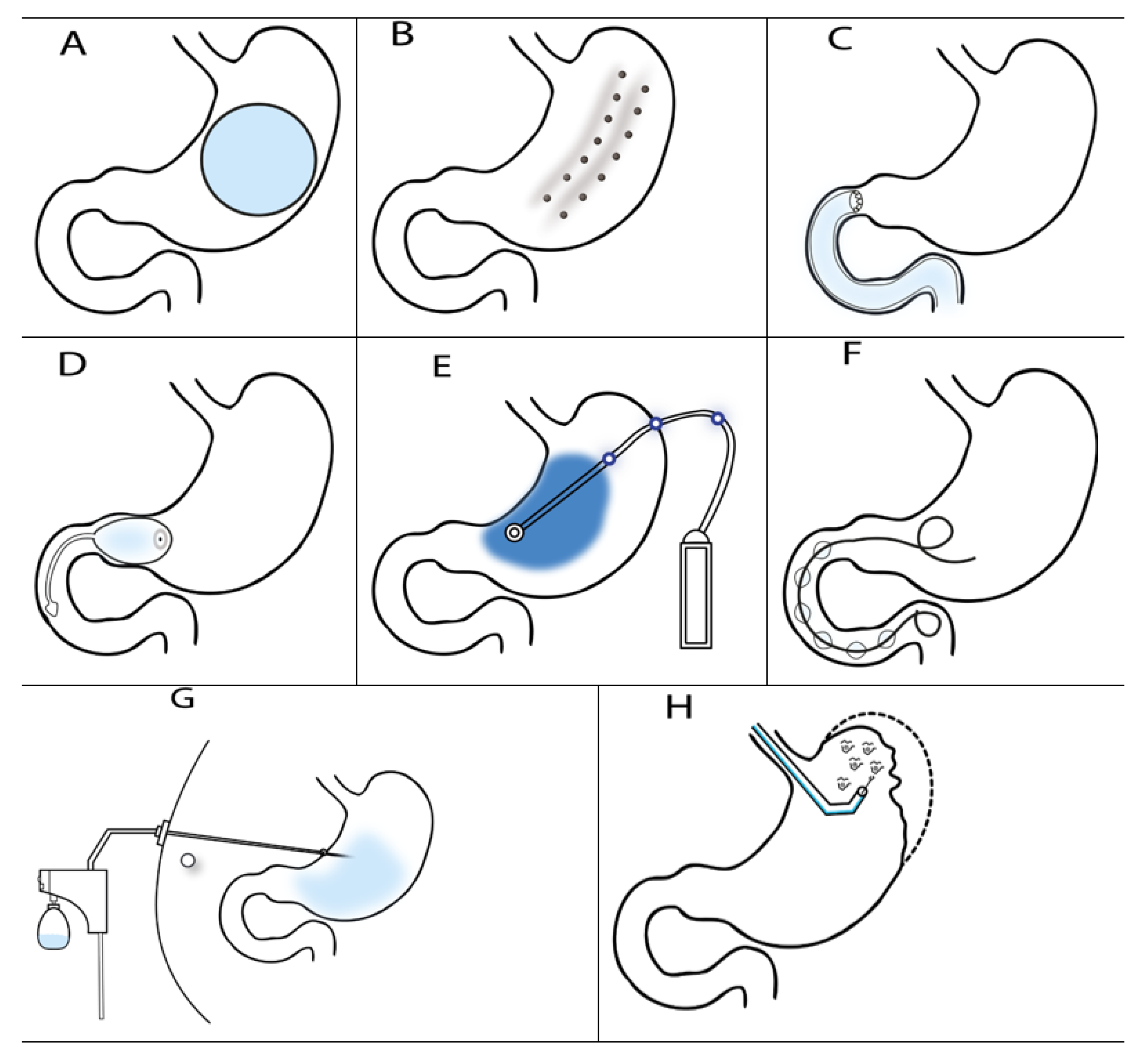 Nutrients Free FullText Endoscopic Treatment of Obesity and
