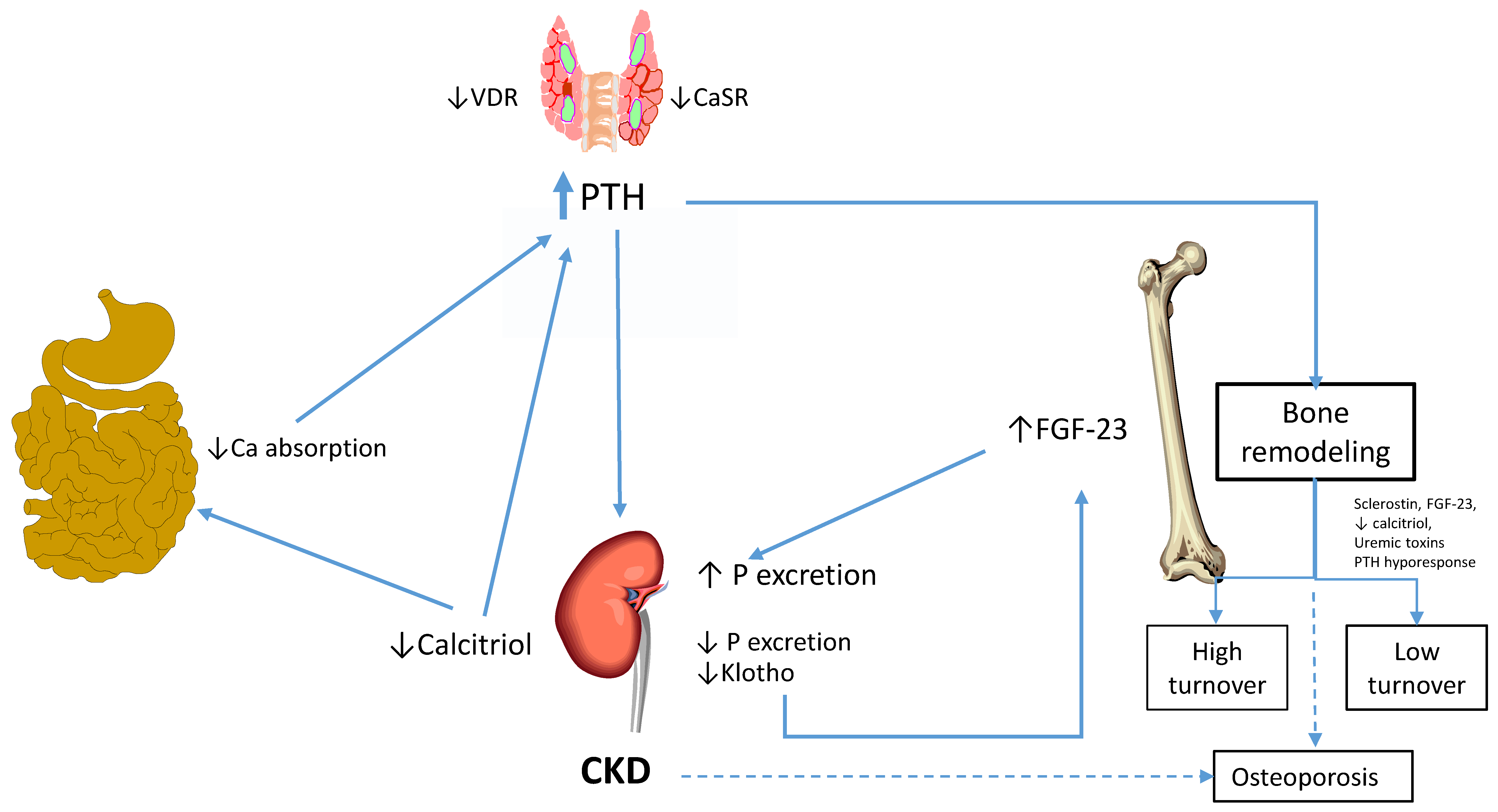 Bone markers in low and high turnover bone disease in CKD