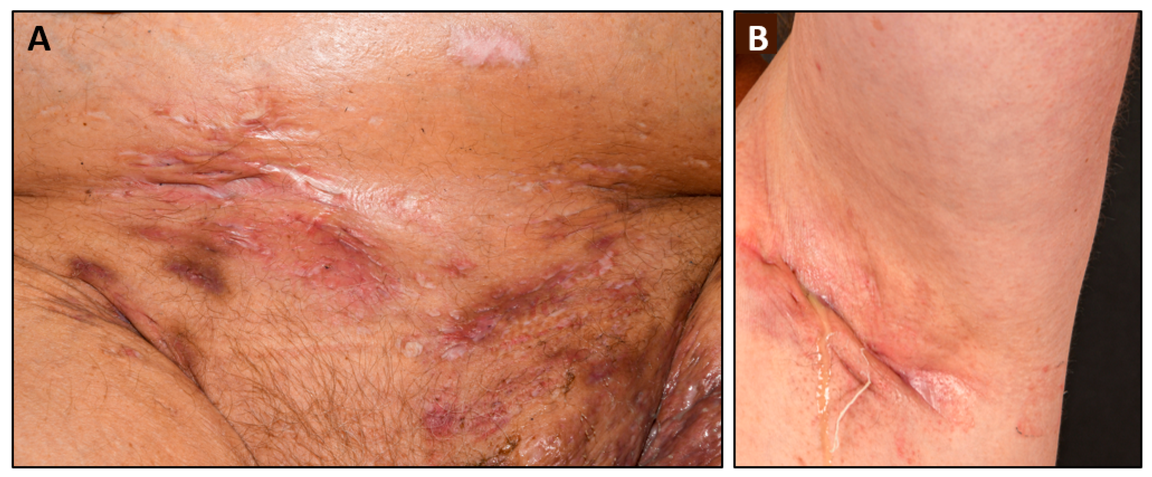 Hidradenitis suppurativa store