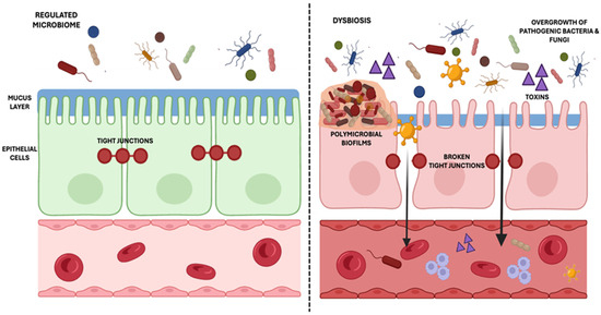 sibo and semaglutide Small Intestinal Bacterial and Fungal Overgrowth: Health Implications and  Management Perspectives