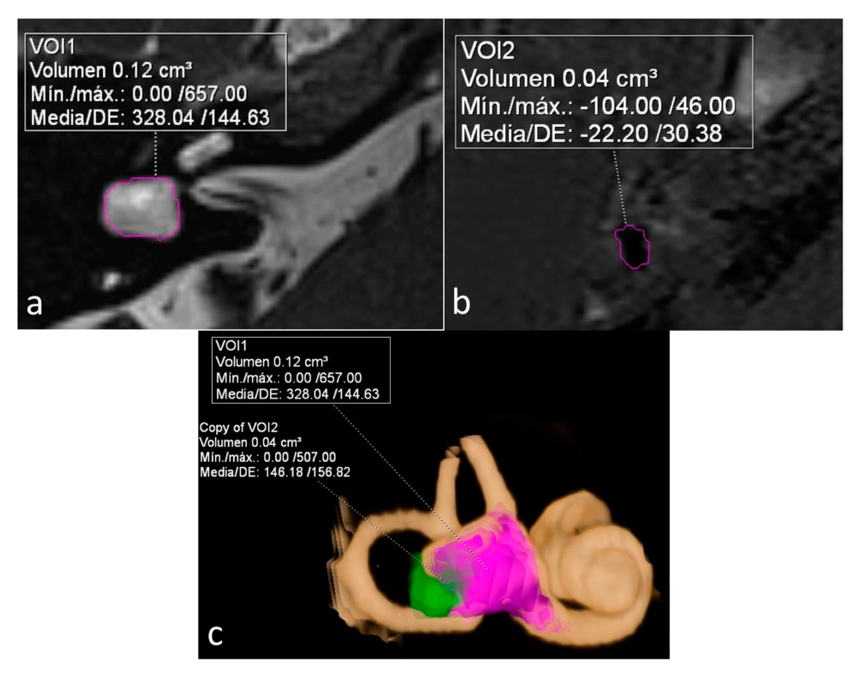 JOHBM Free FullText MRI Evaluation of Vestibular Endolymphatic