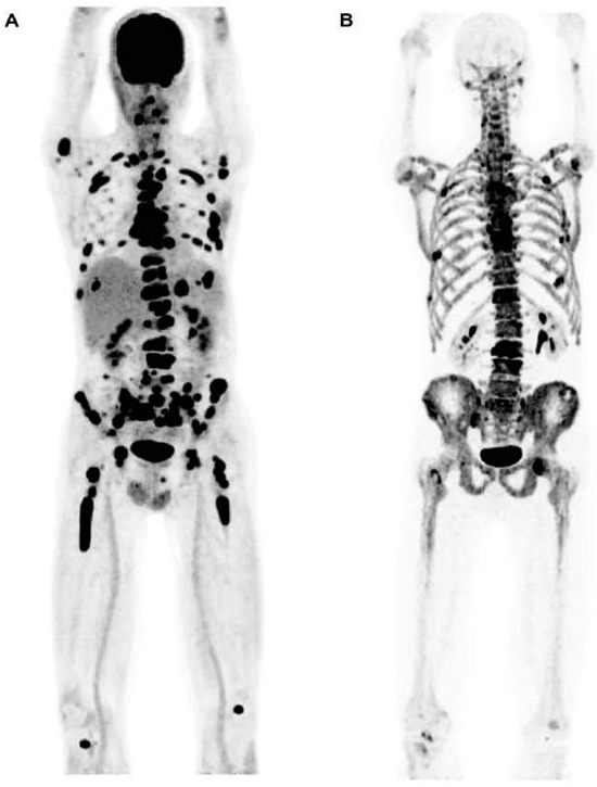 Significance of PET/CT Imaging in Myeloma Assessment: Exploring Novel ...