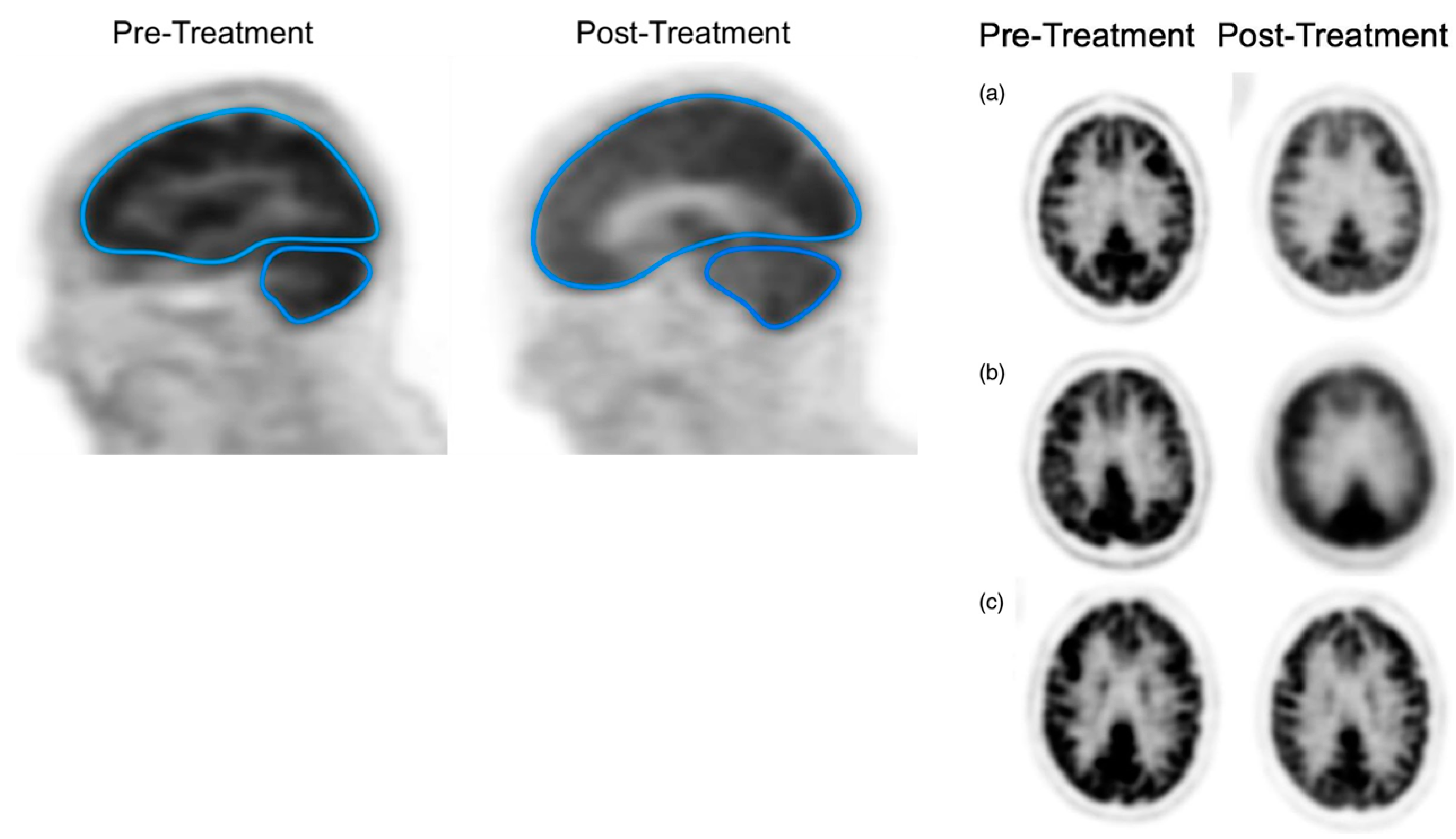 Significance of PET/CT Imaging in Myeloma Assessment