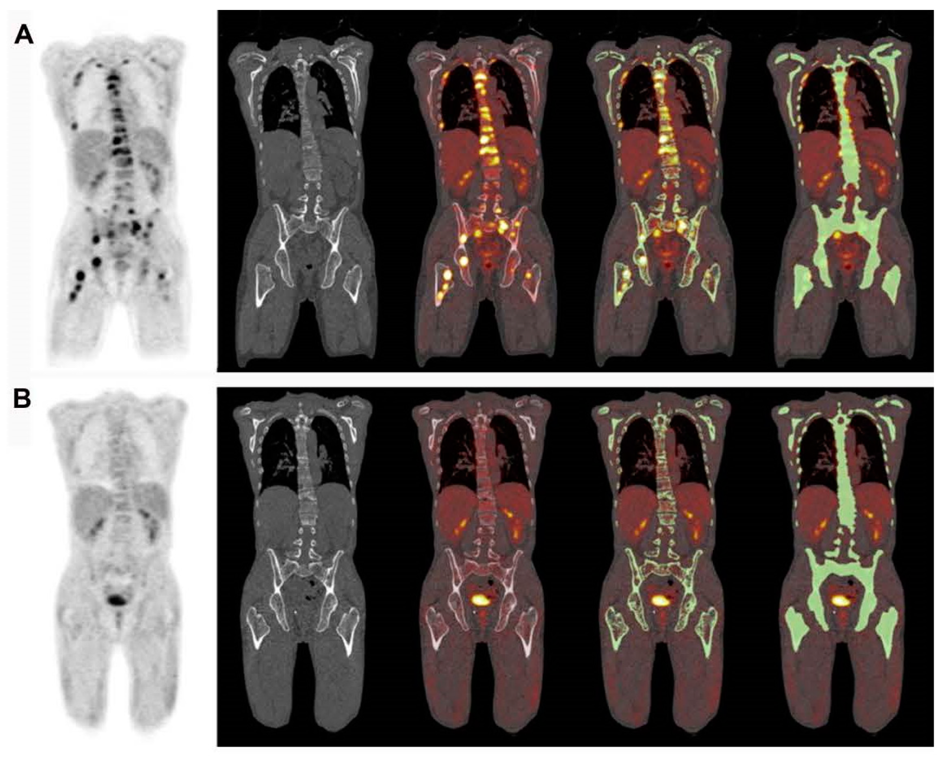 Significance of PET/CT Imaging in Myeloma Assessment: Exploring Novel ...