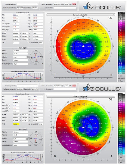 Rigid Gas-Permeable Semi-Scleral Contact Lenses after Radial Keratotomy ...
